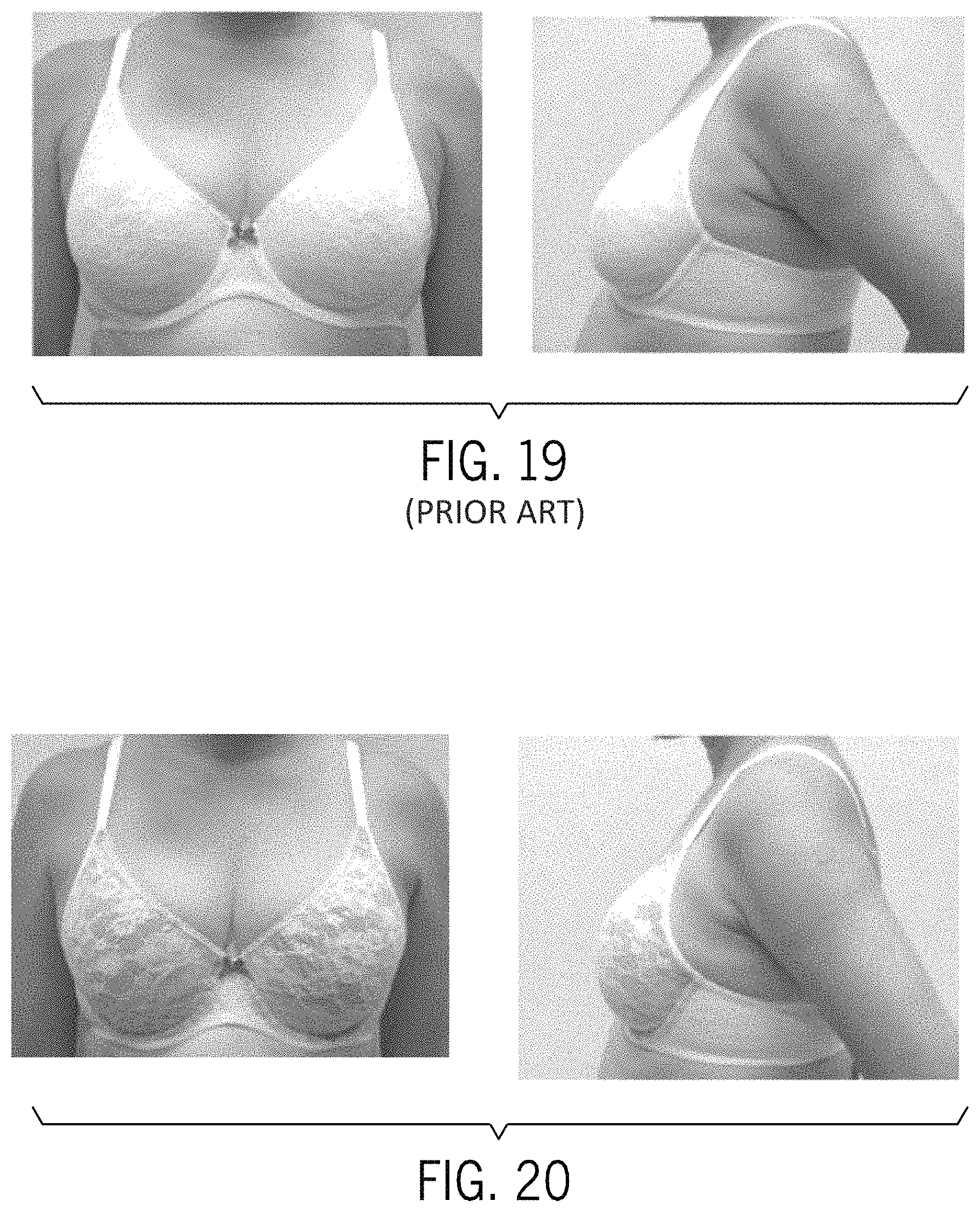 Patent US11771144 Figure 11 – Bra, bra cup, and method of manufacturing same