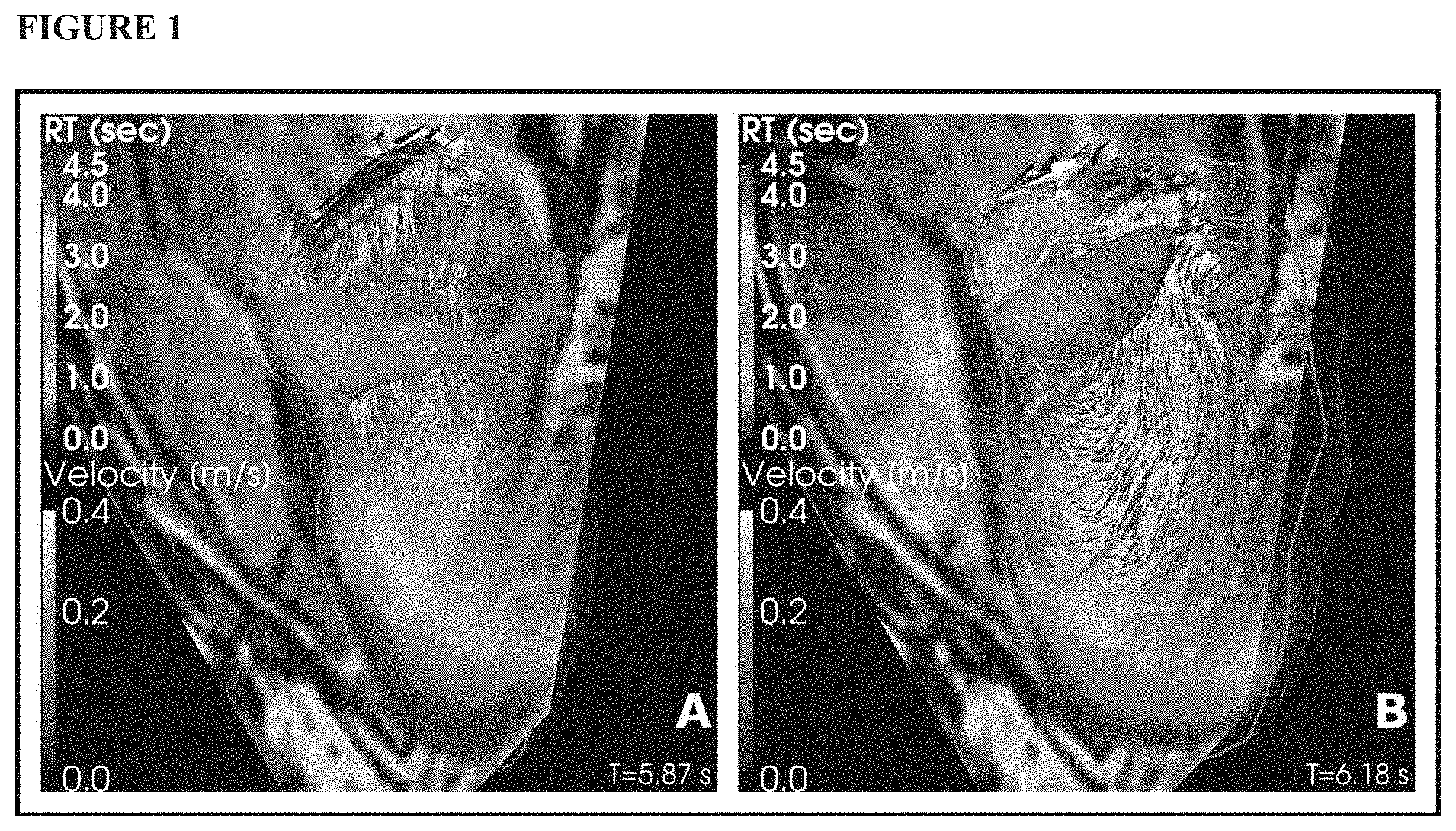 Patent US11771379 — Mapping and quantifying blood stasis and thrombus risk in the heart — Figure 1