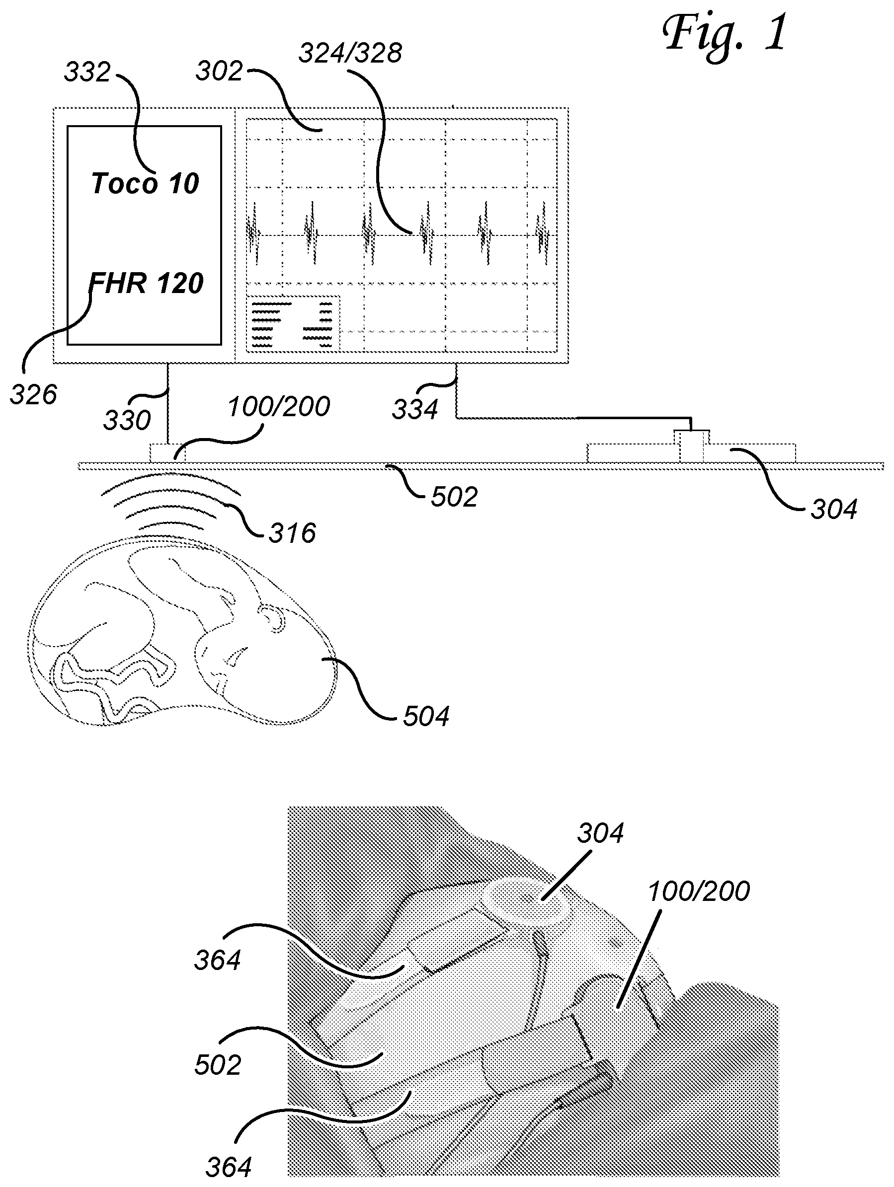 Patent US11771398 — Fetal heart rate transducer — Figure 1