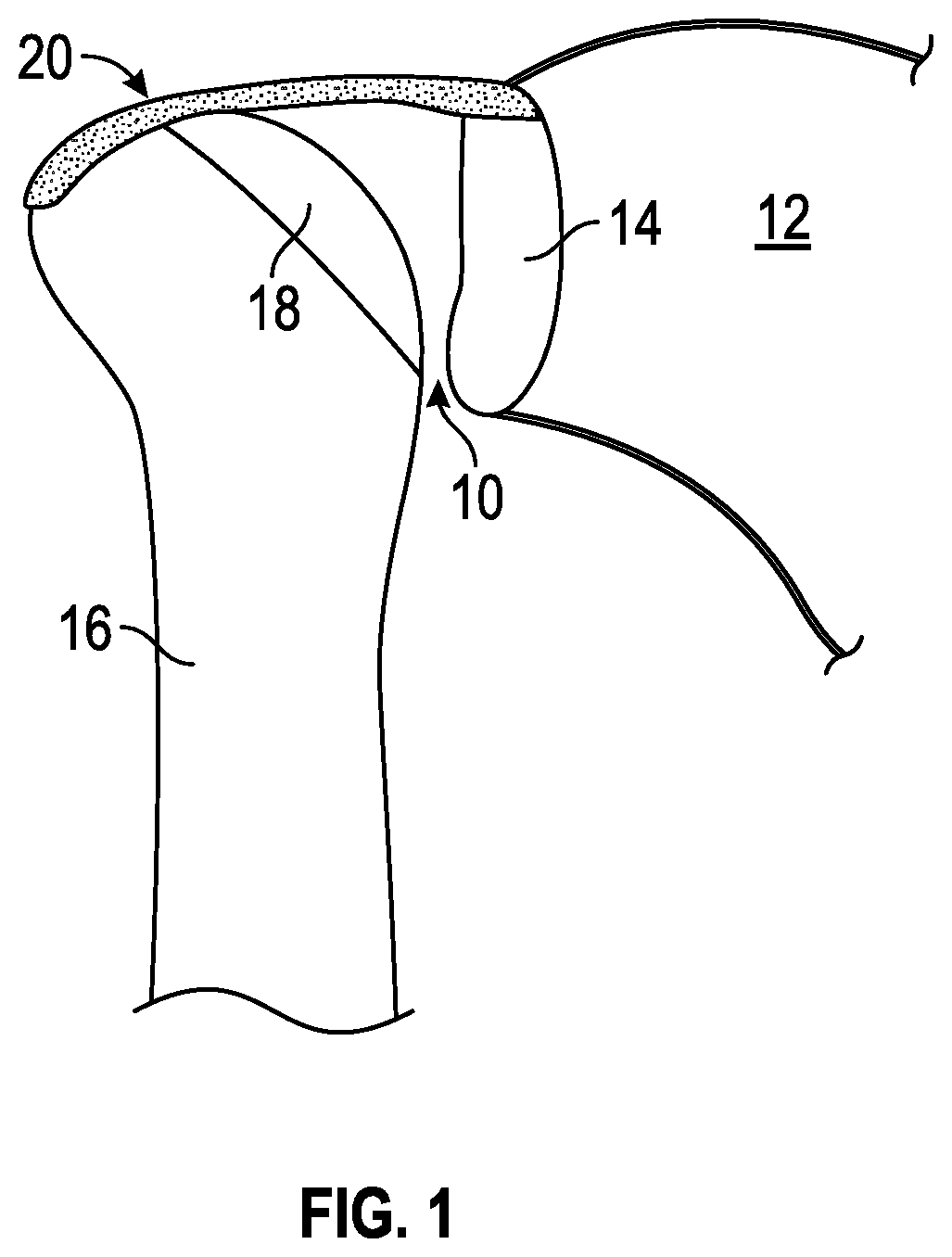 Patent US11771416 Figure 1 – Surgical tools and associated graft augmentation techniques