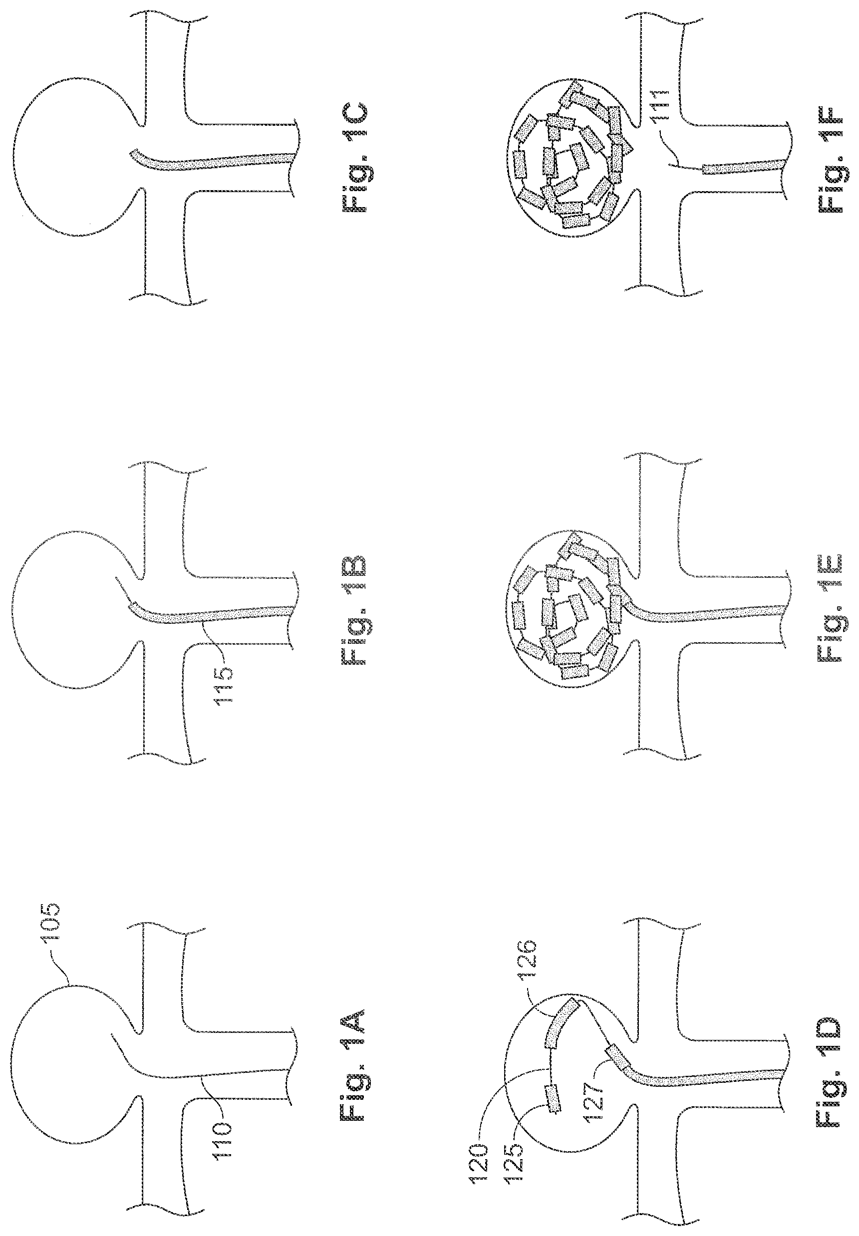 Patent US11771435 — Expandable implant and implant system — Figure 1