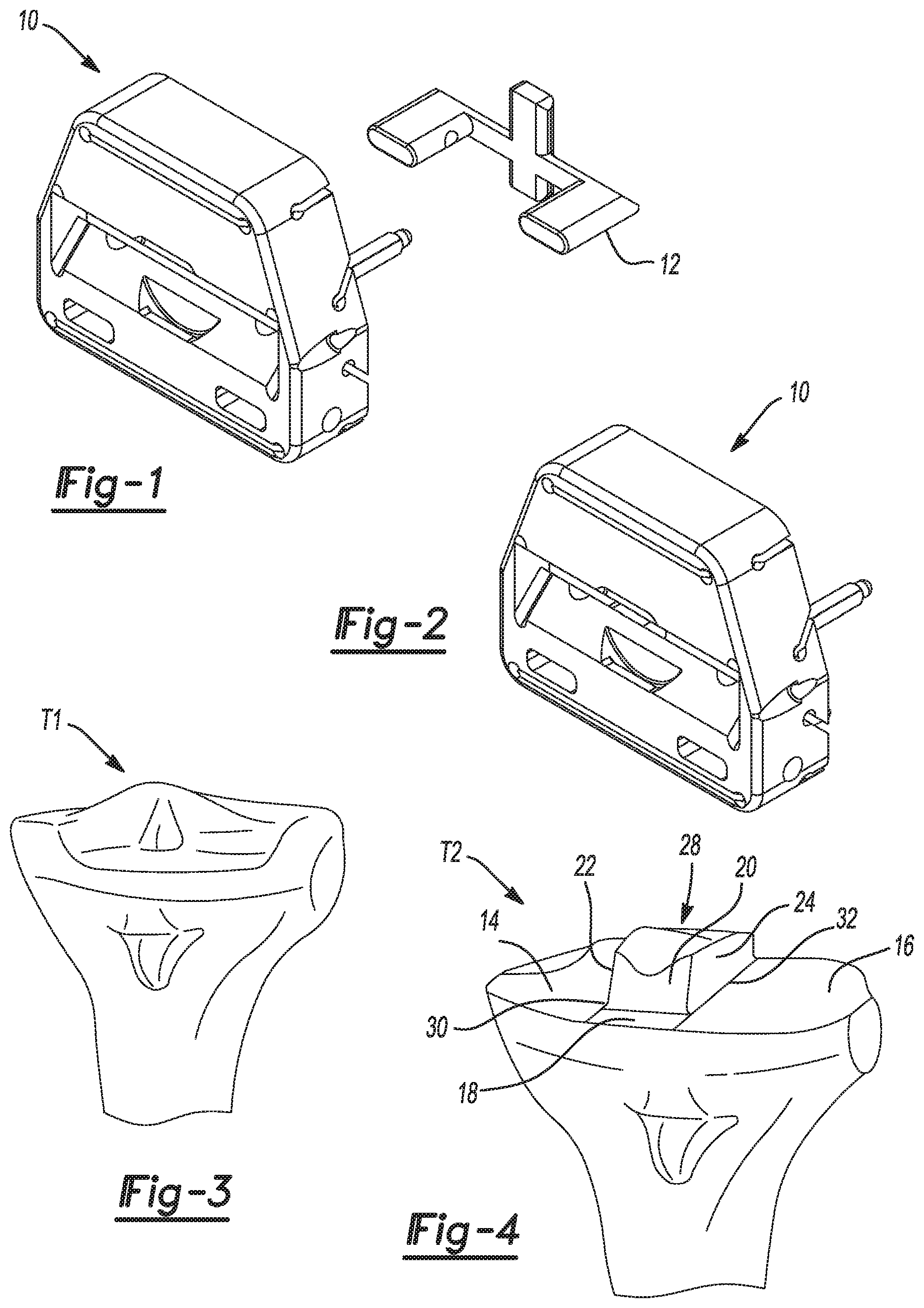 Patent US11771442 Figure 1 – Bi-cruciate knee system