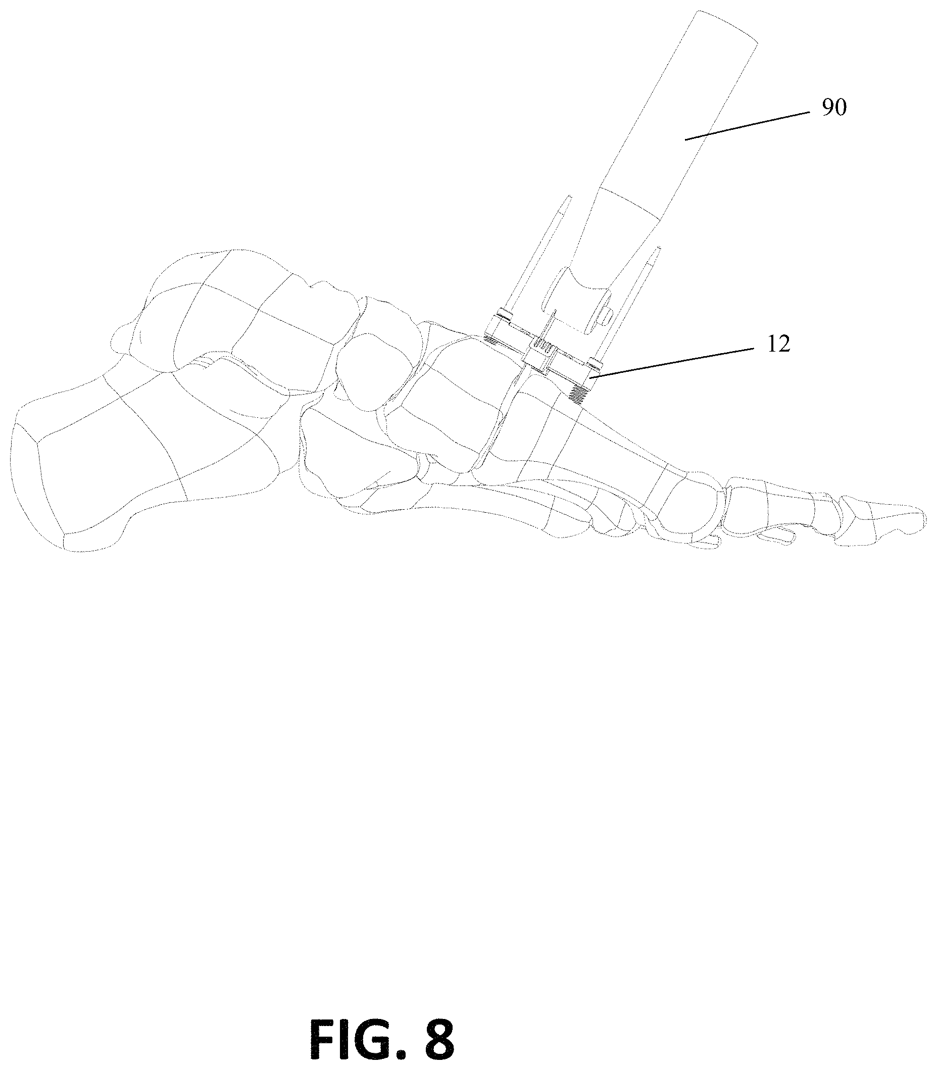 Patent US11771443 Figure 17 – Joint spacer systems and methods