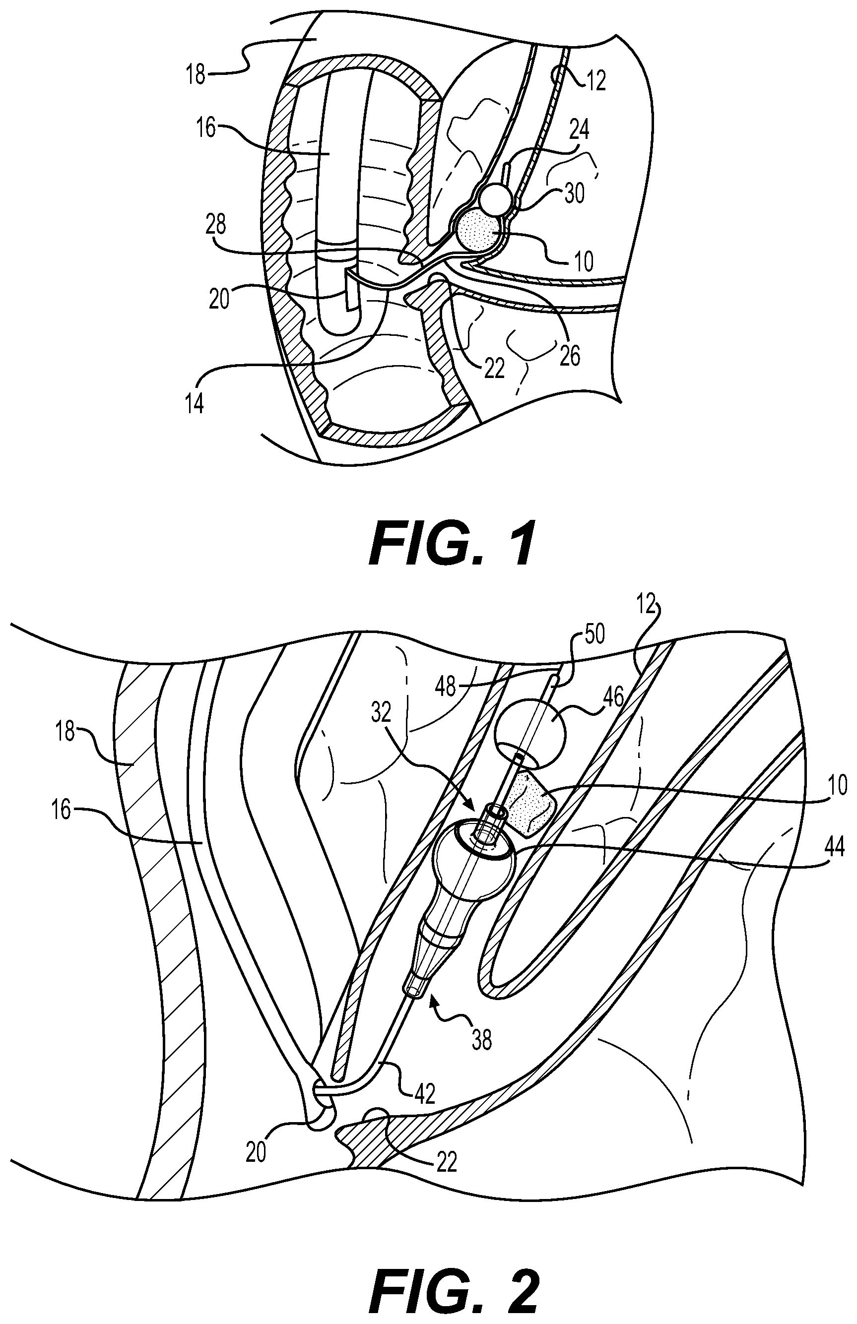 Patent US11771444 — Medical instrument having a balloon and an extraction member — Figure 1