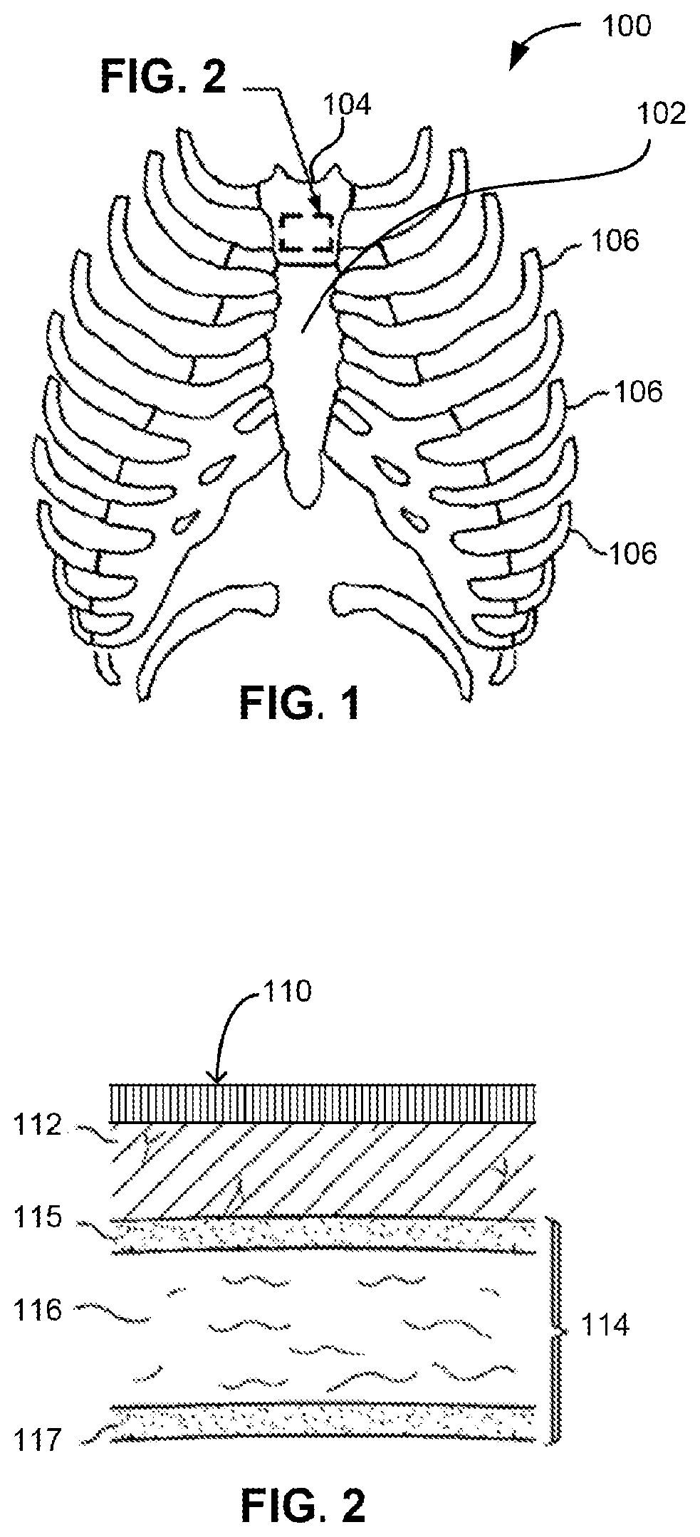 Patent US11771462 Figure 1 – Sternal locators and associated systems and methods