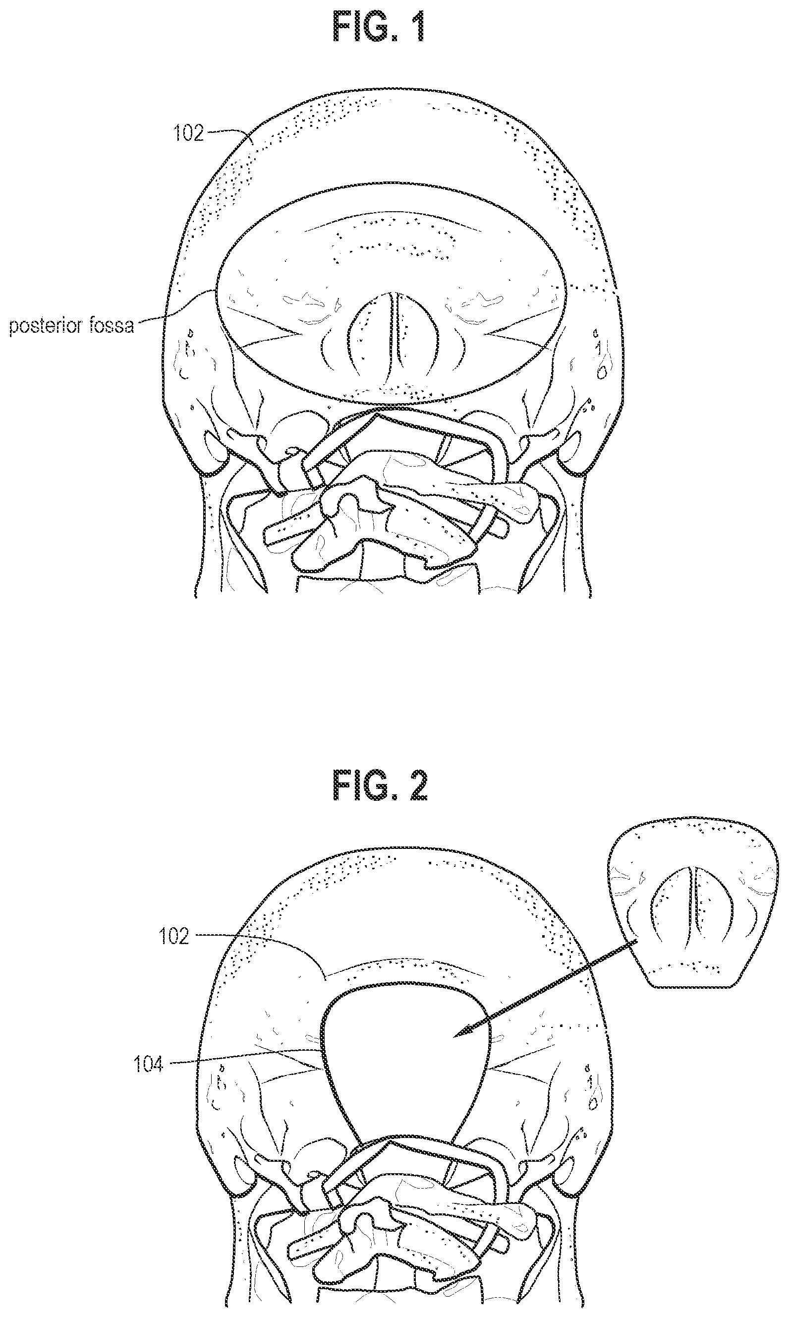 Patent US11771470 — Affixation device for securing bone flap — Figure 1