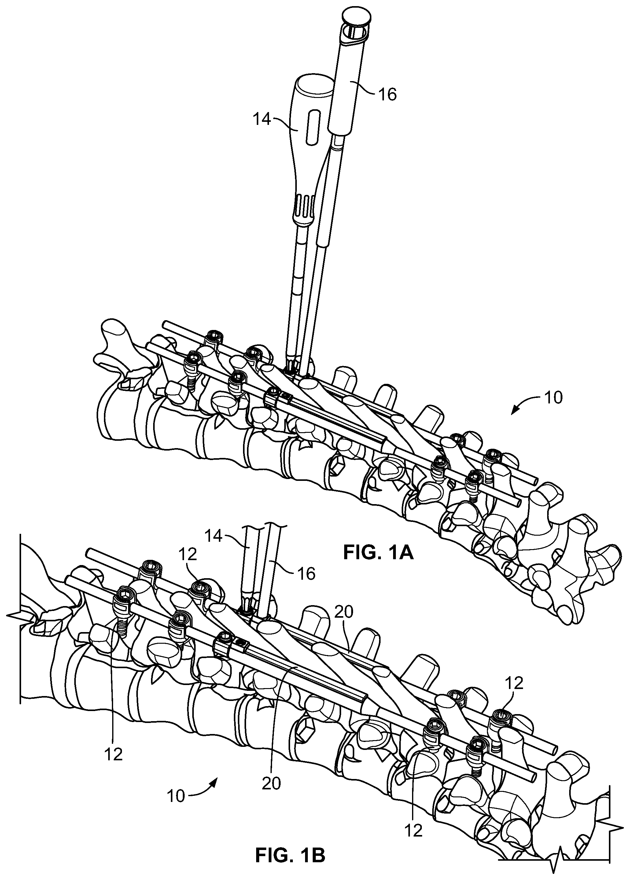Patent US11771471 — Growing rods and methods of use — Figure 1