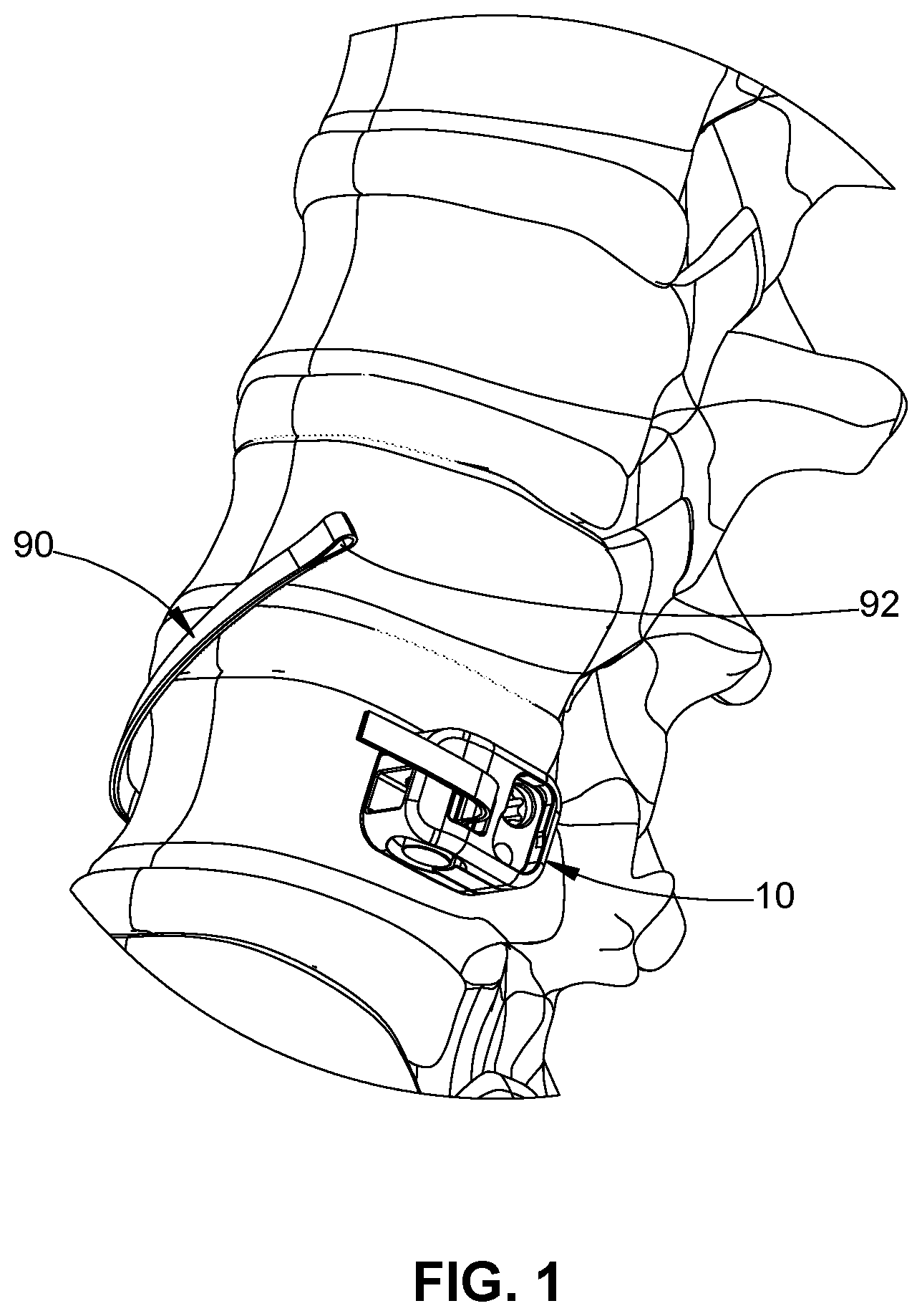 Patent US11771474 — Band tensioning system — Figure 1
