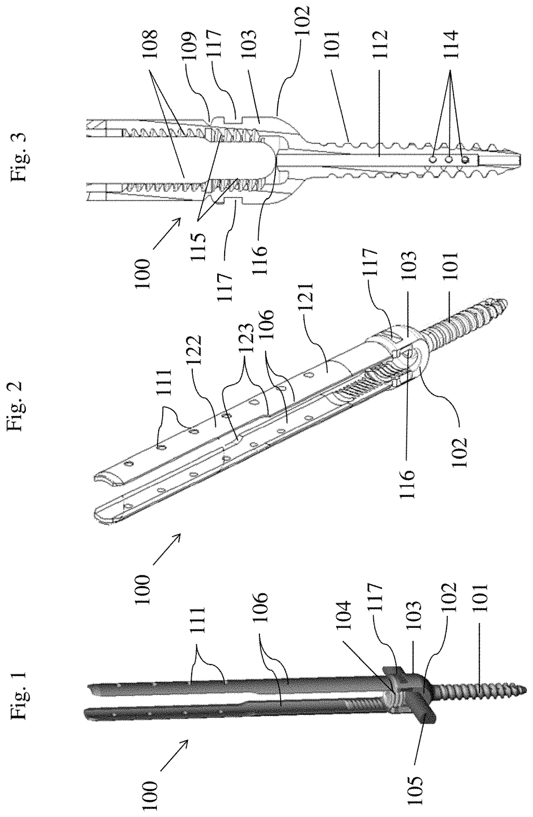 Patent US11771476 — Apparatus and method for fenestrated screw augmentation — Figure 1