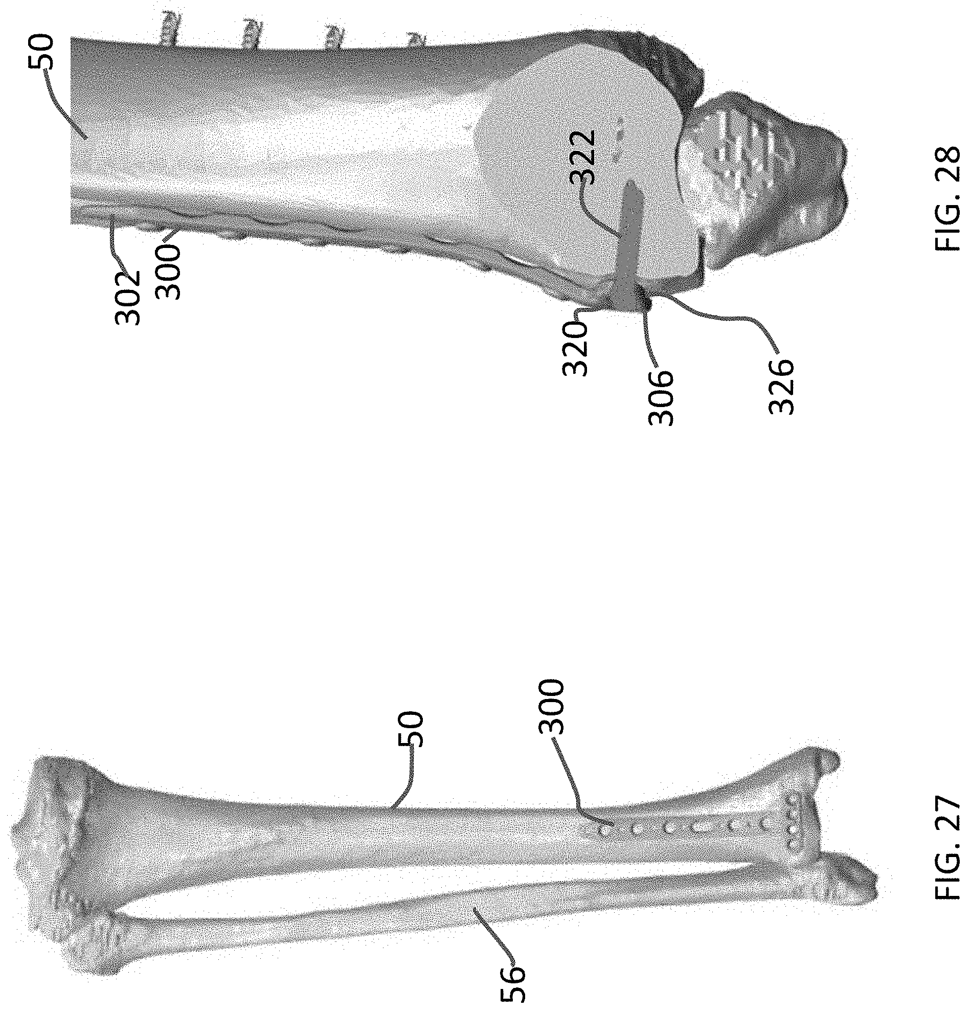 Patent US11771480 Figure 12 – Distal tibial plating system