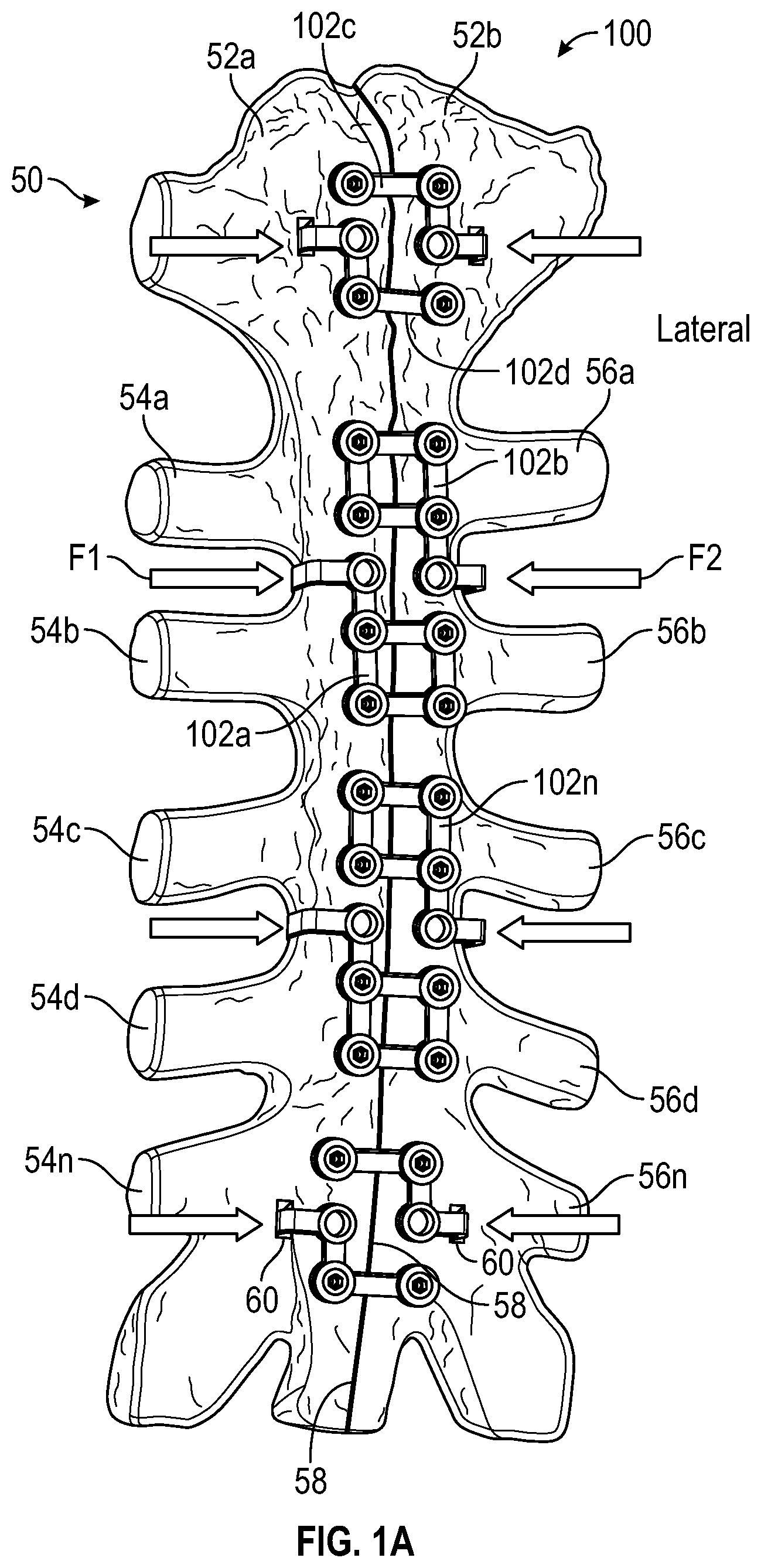 Patent US11771481 — Sternal plates and methods of use — Figure 1