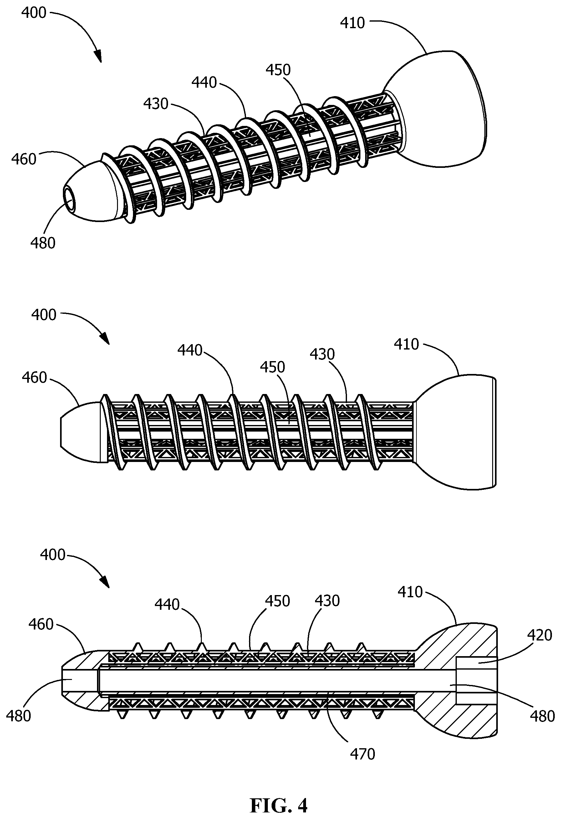 Patent US11771482 Figure 4 – Implants for tissue fixation and fusion
