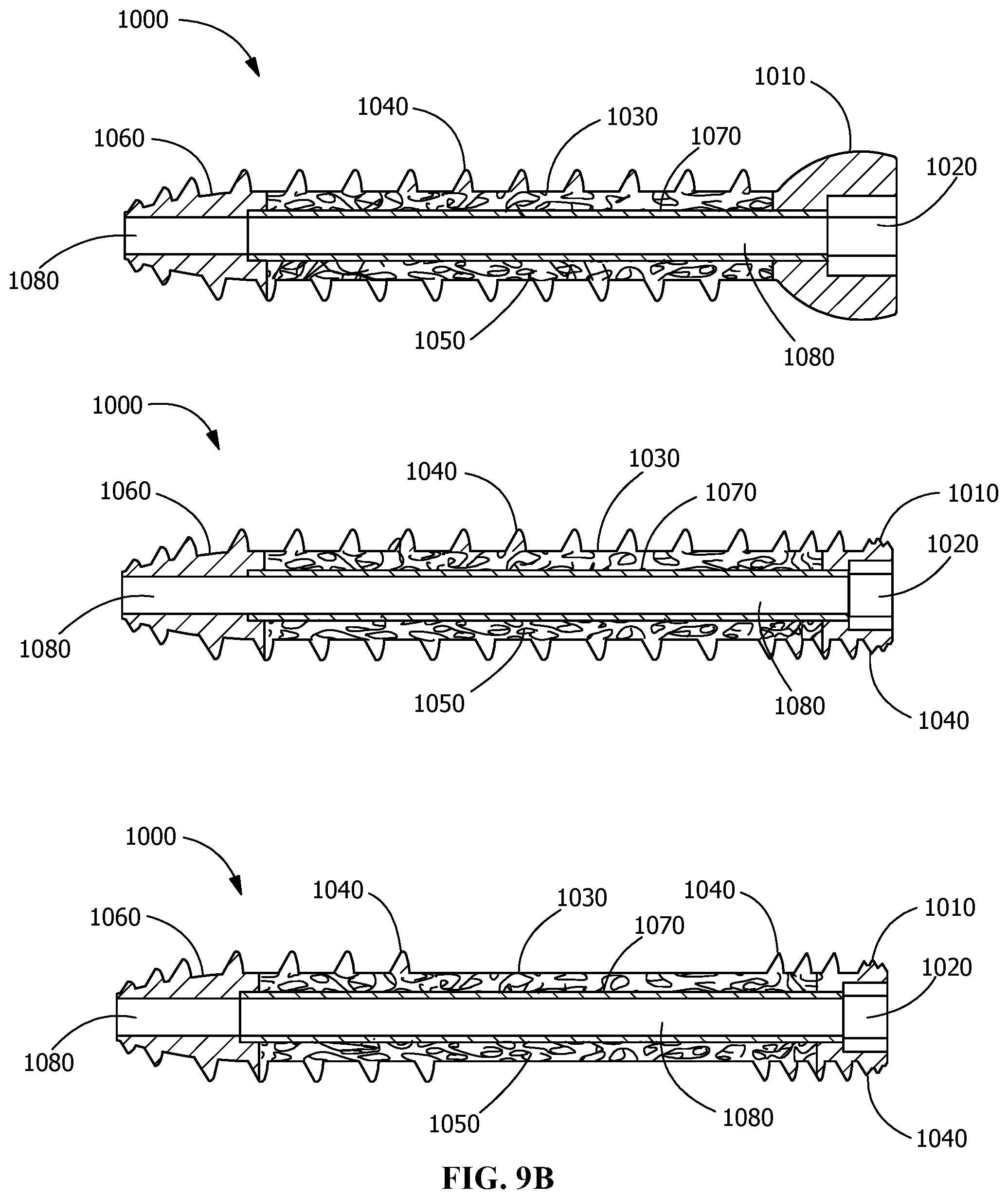 Patent US11771482 Figure 10 – Implants for tissue fixation and fusion