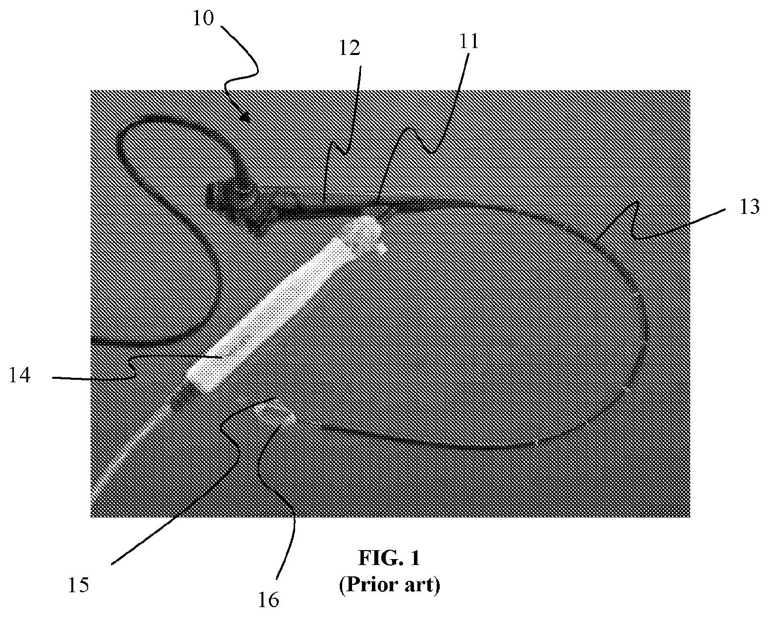 Patent US11771492 — Systems and methods for improved delivery of expandable catheter assemblies into body lumens — Figure 1