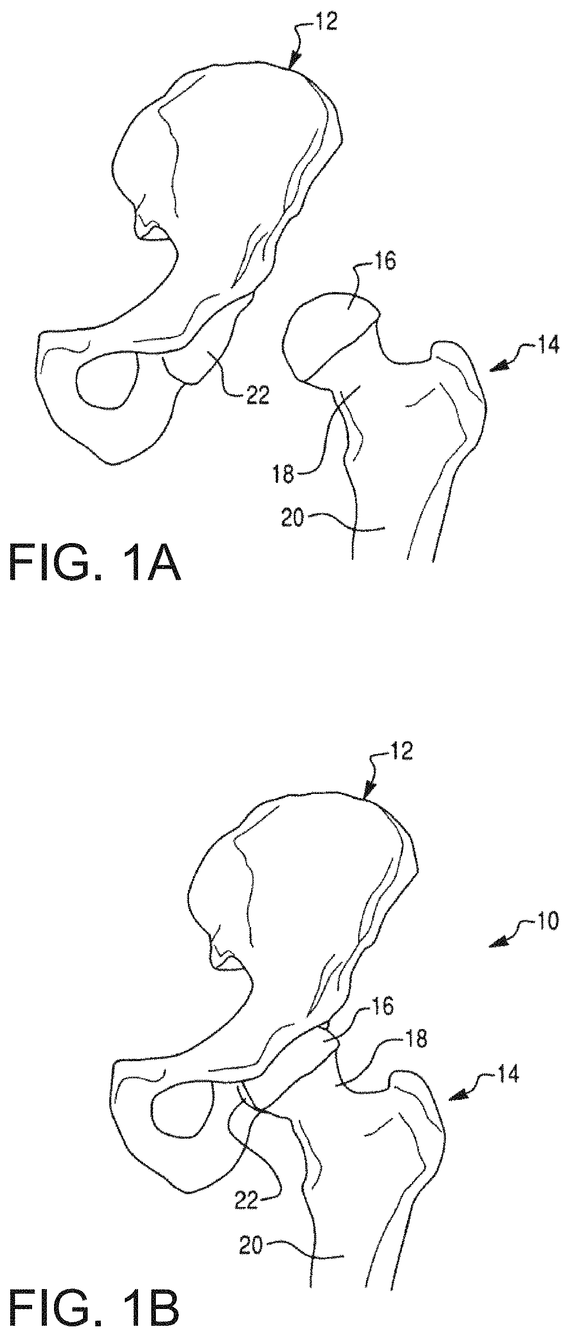 Patent US11771498 — Lower extremities leg length calculation method — Figure 1