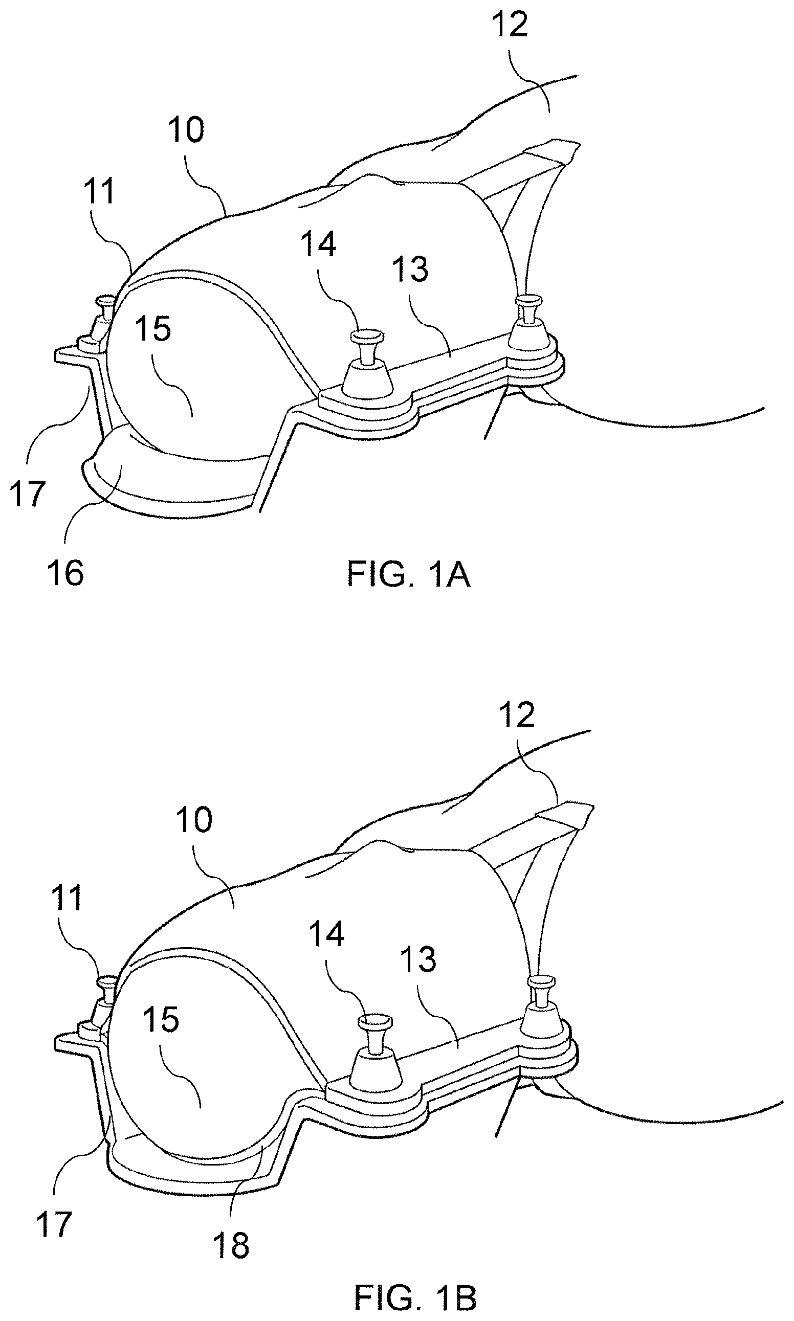 Patent US11771516 — Adjustable immobilizer apparatus and method for immobilizing a patient — Figure 1