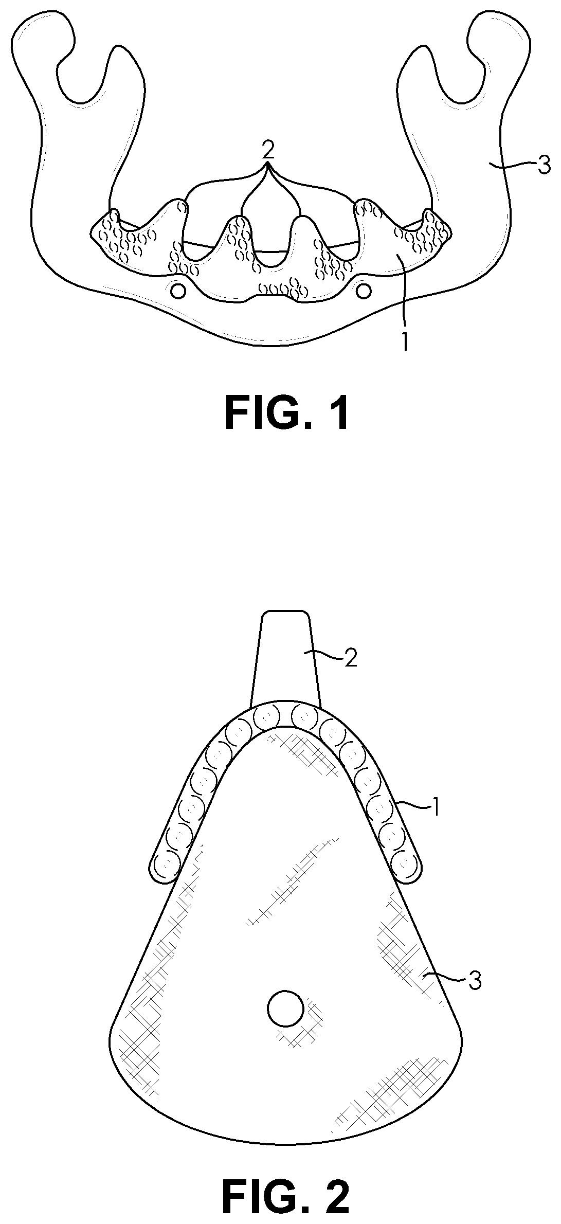 Patent US11771529 — Customized porous supracrestal implant and materials and methods forming them — Figure 1
