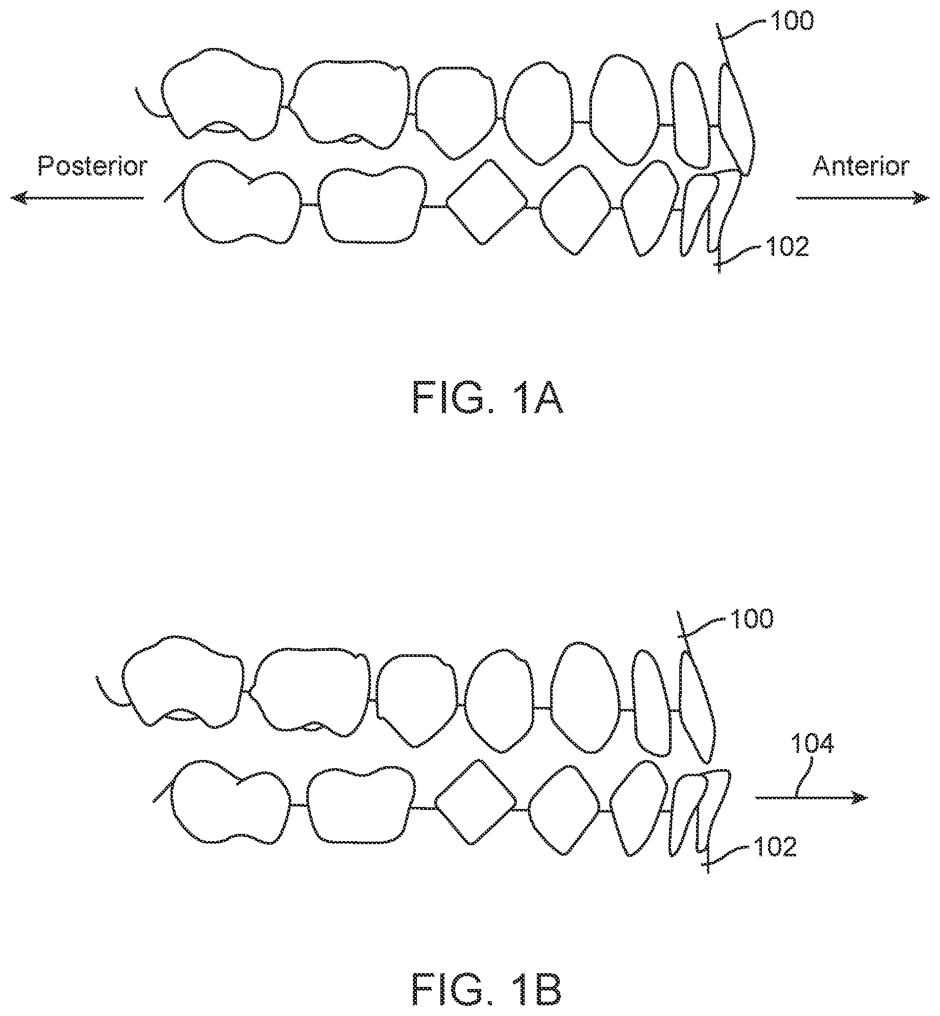 Patent US11771531 Figure 1 – Mandibular advancement and retraction via bone anchoring devices