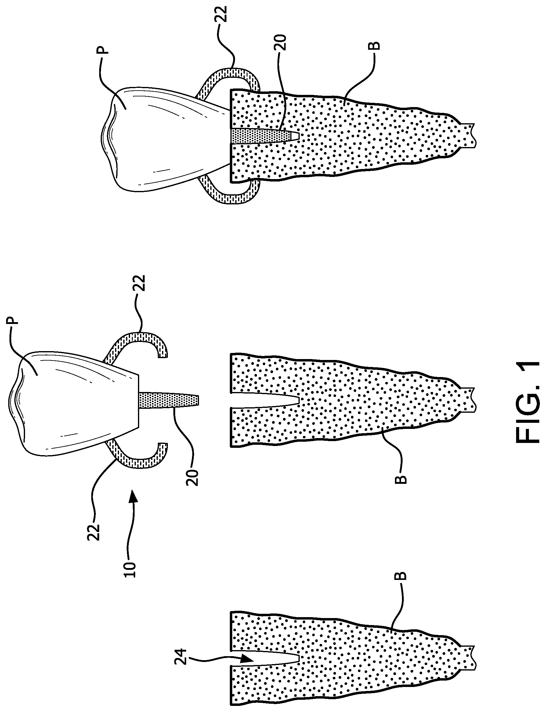 Patent US11771537 — MElHOD for dynamically guiding a dental oral and maxillofacial prosthesis — Figure 1