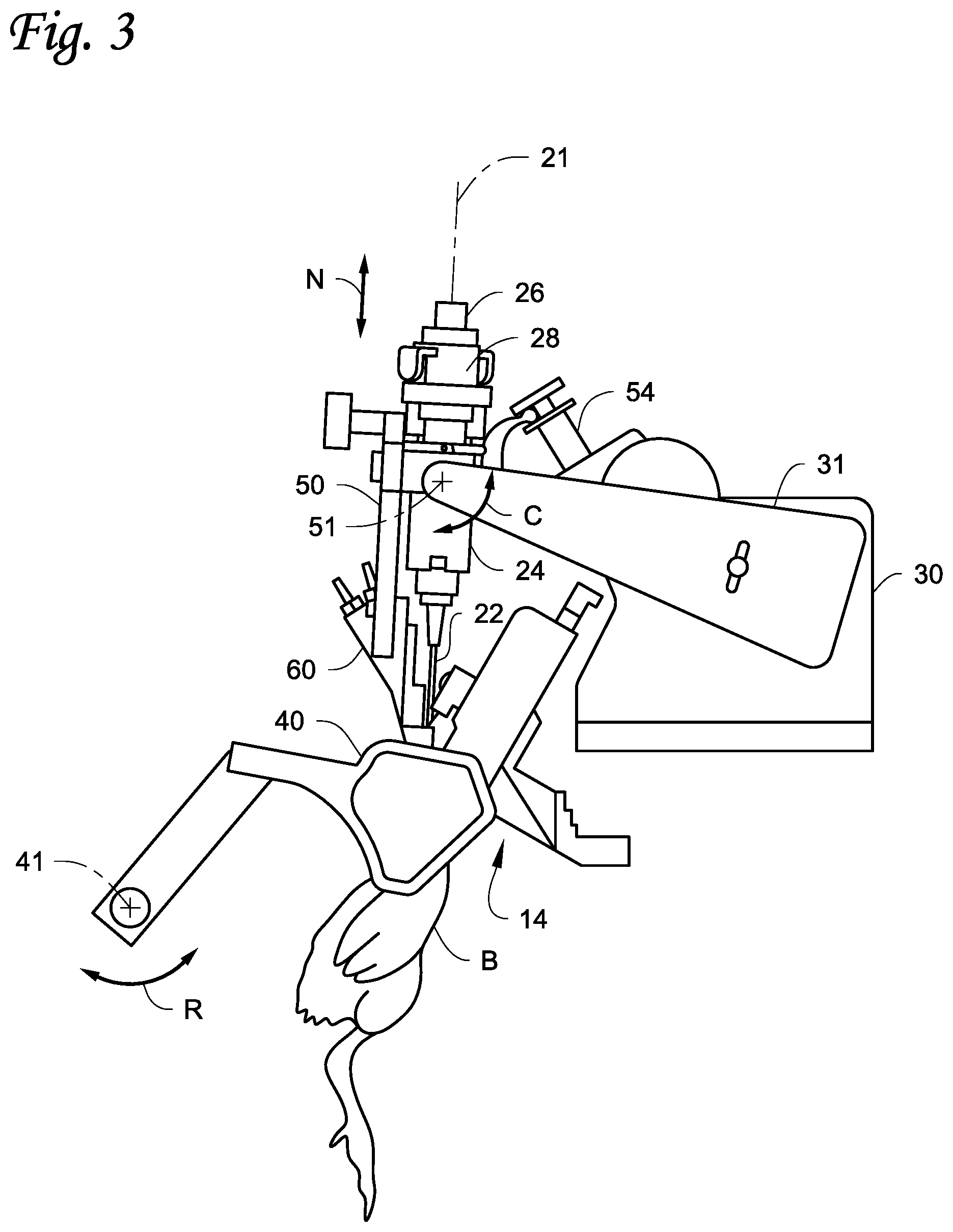 Patent US11771538 Figure 3 – Injection systems and methods