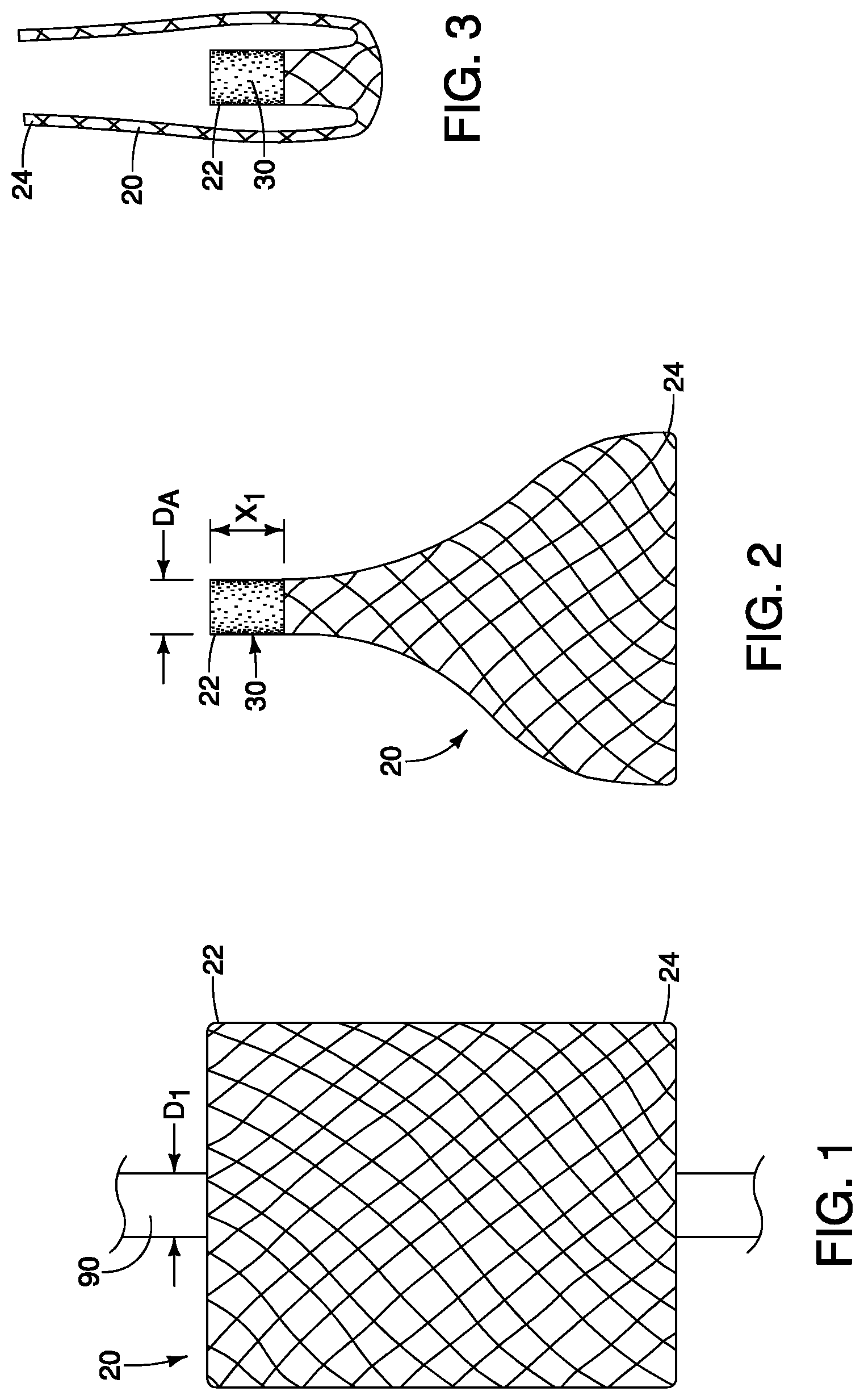 Patent US11771541 — Expandable mesh with locking feature — Figure 1