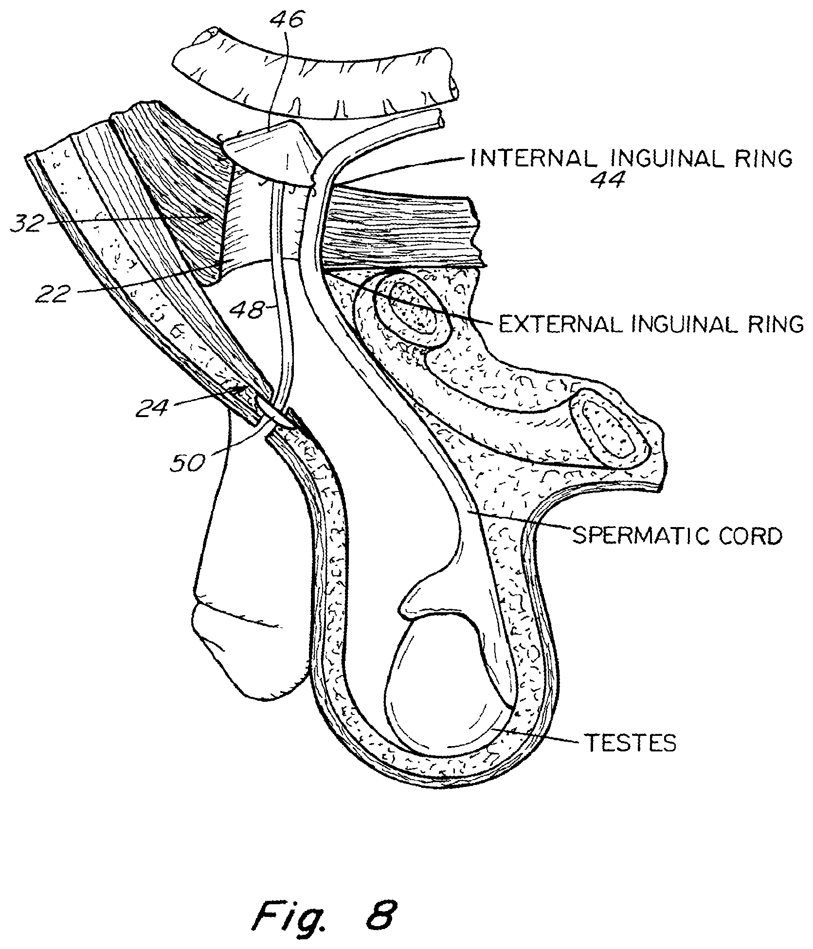 Patent US11771542 Figure 8 – Method and prosthesis for percutaneous hernia repair
