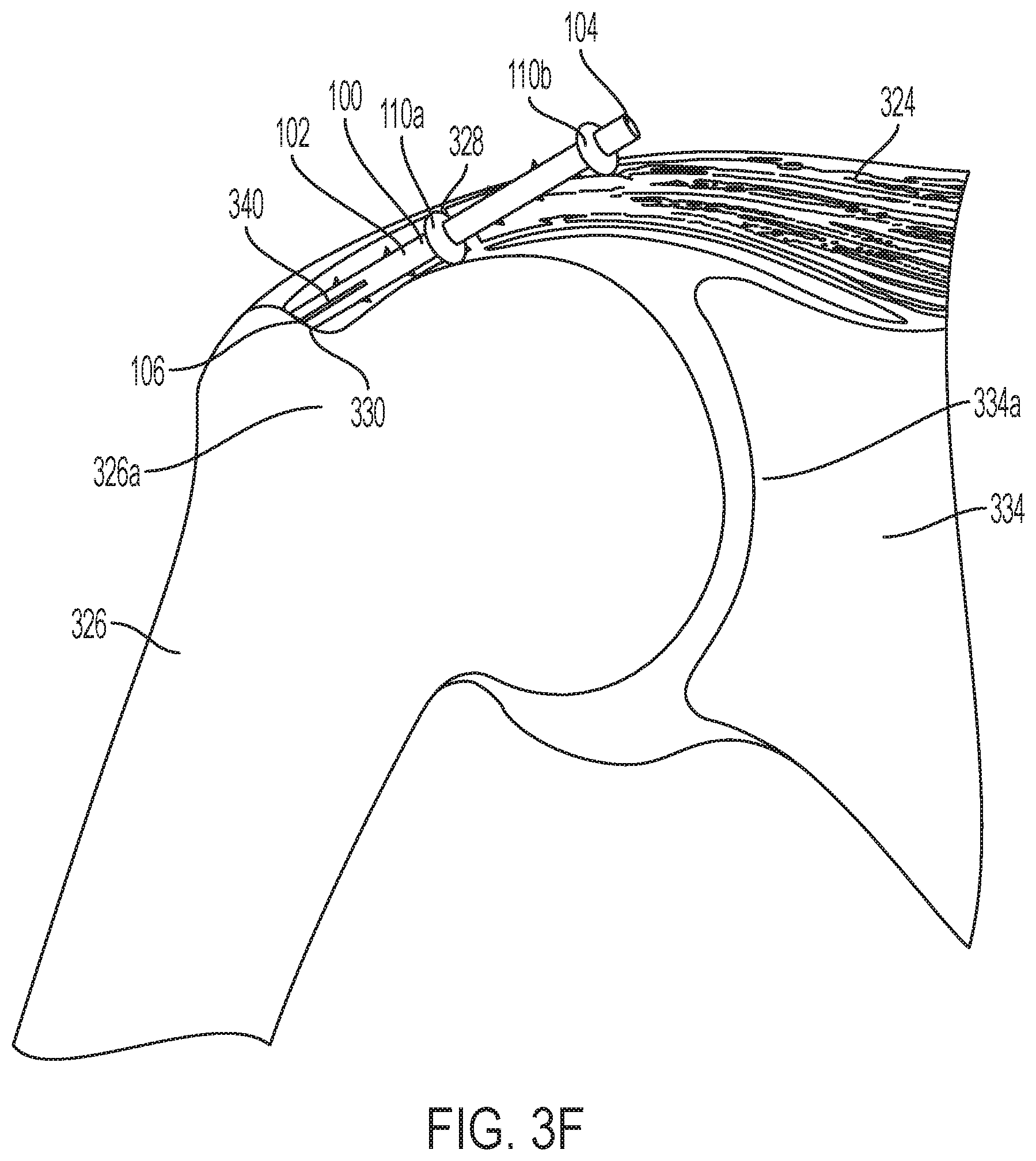 Patent US11771549 Figure 8 – Implantable articles for attaching tendons and/or ligaments to bone and/or cartilage, assemblies thereof, and methods of use thereof