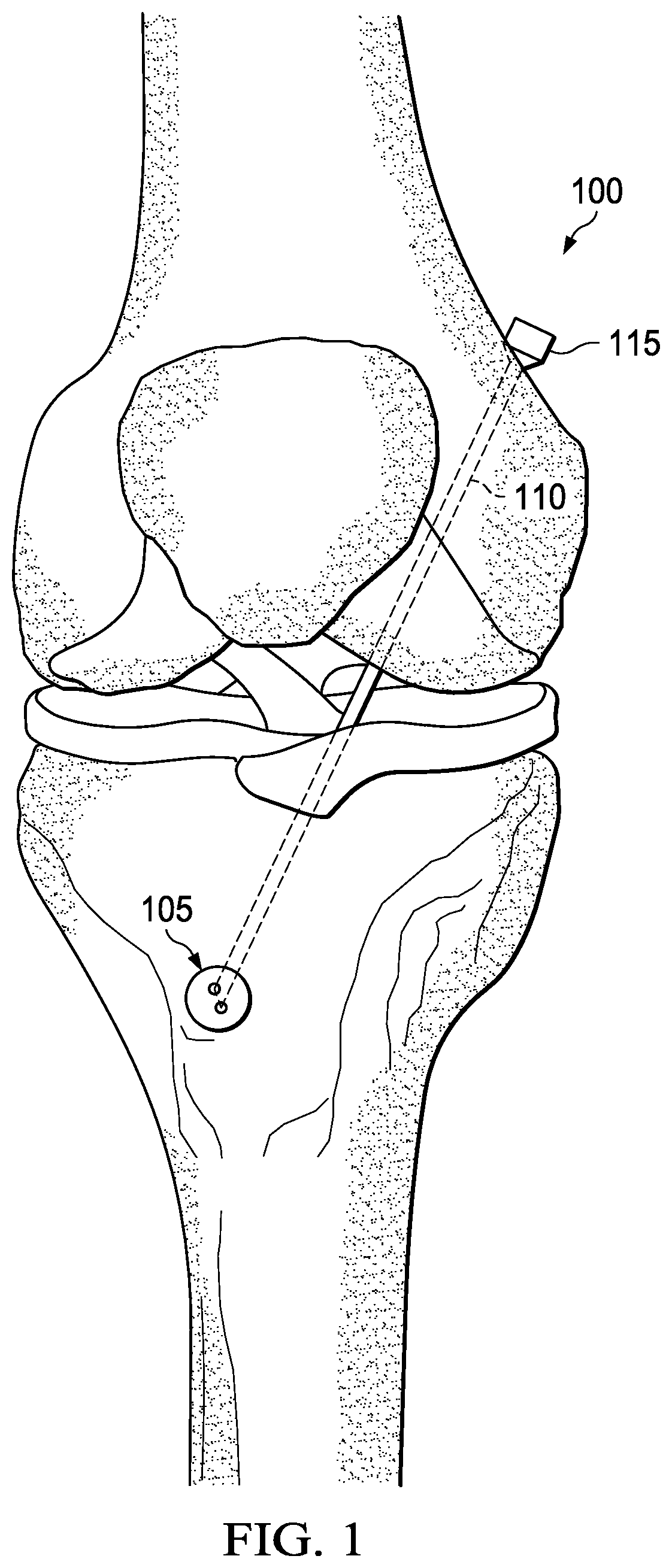 Patent US11771550 — Safe-release bone fastener for use with a ligament augmentation strap — Figure 1