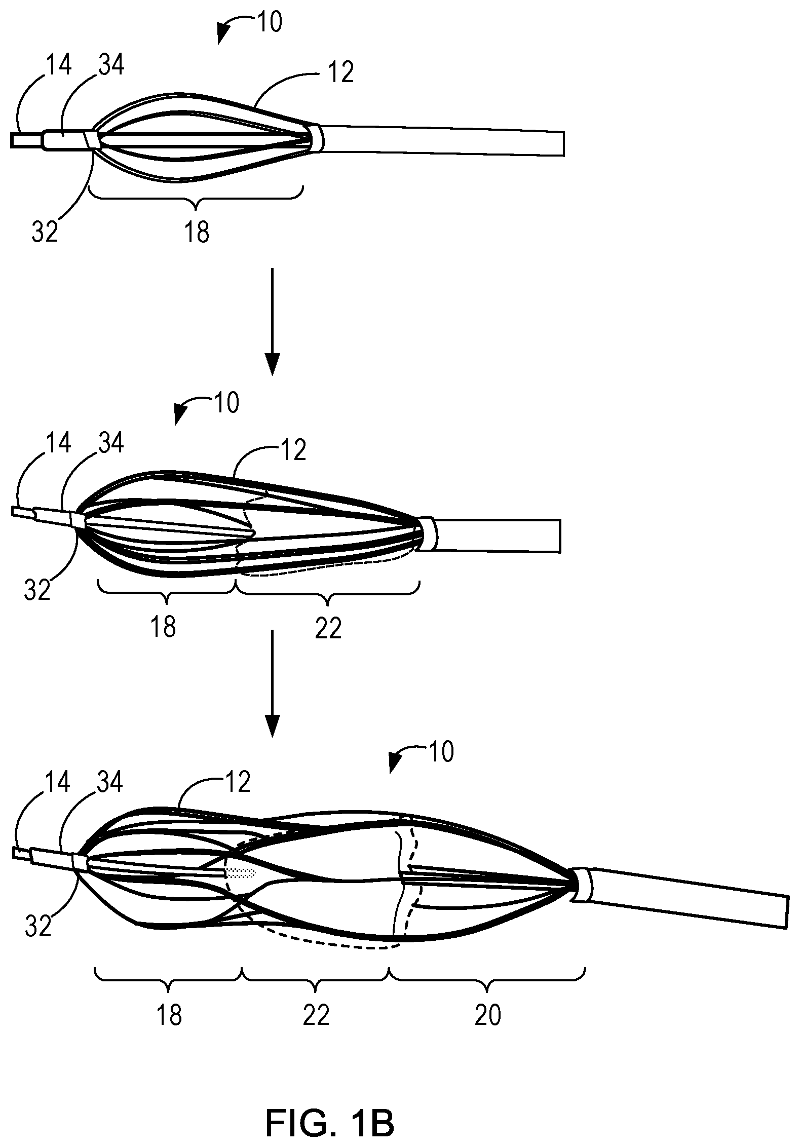 Patent US11771555 Figure 2 – Retrievable self-expanding non-thrombogenic low-profile percutaneous atrioventricular valve prosthesis