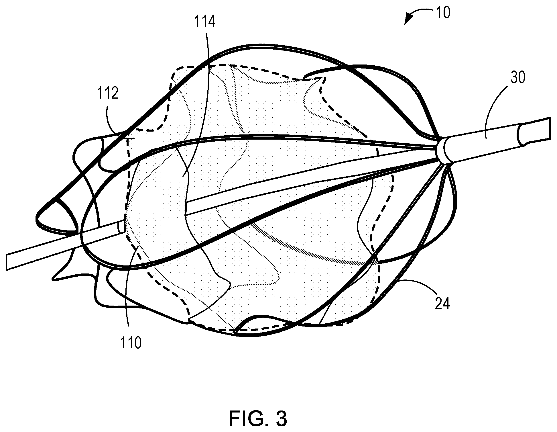 Patent US11771555 Figure 4 – Retrievable self-expanding non-thrombogenic low-profile percutaneous atrioventricular valve prosthesis