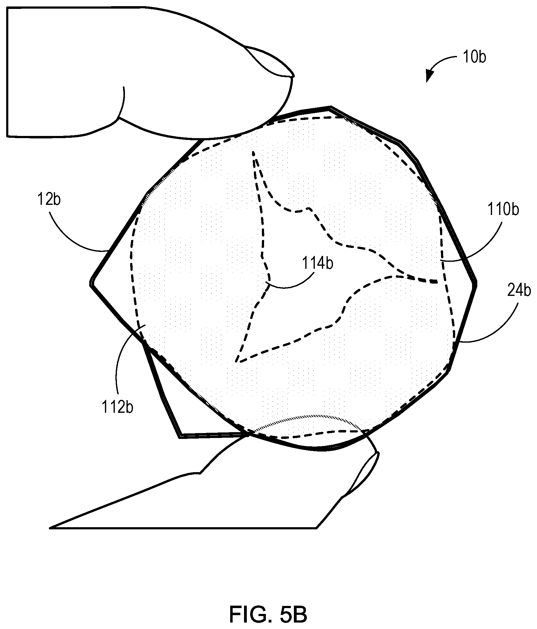 Patent US11771555 Figure 7 – Retrievable self-expanding non-thrombogenic low-profile percutaneous atrioventricular valve prosthesis