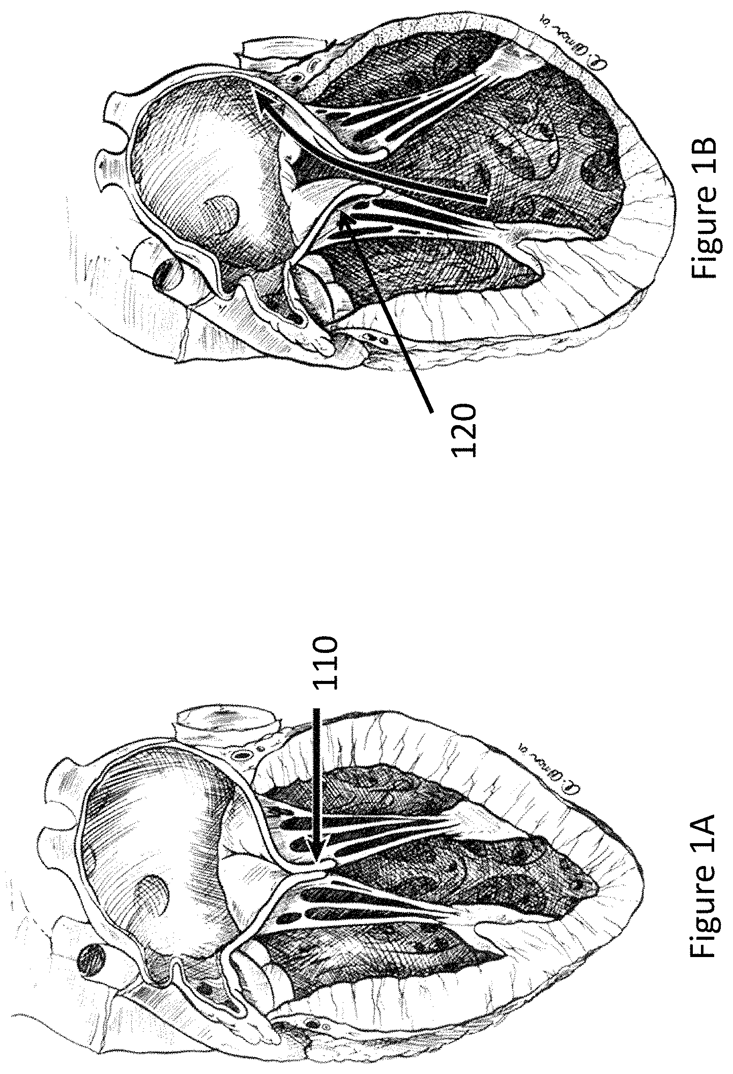 Patent US11771557 — Apparatus and method to reshape geometry of diseased heart valve — Figure 1