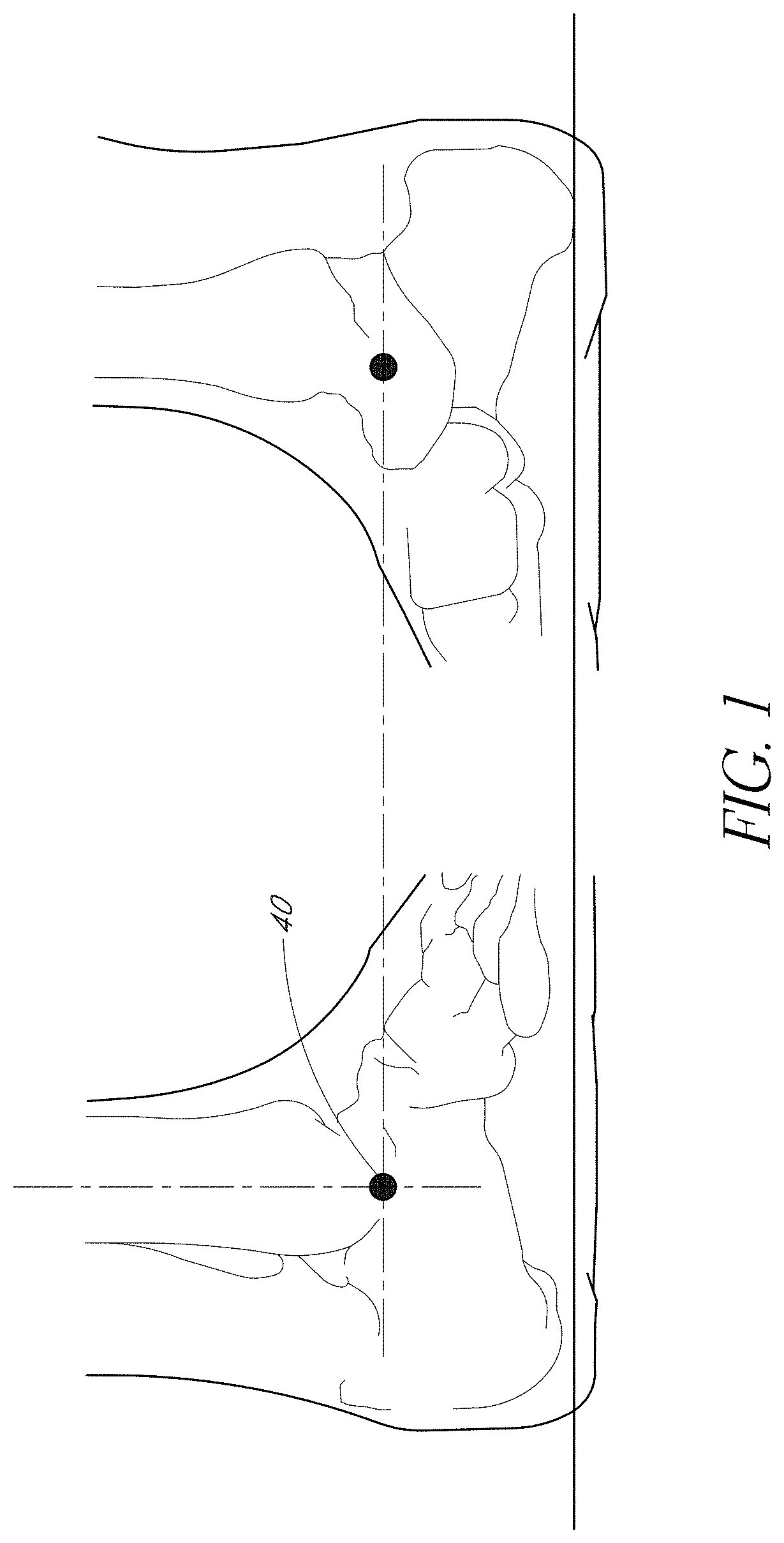 Patent US11771572 — Prosthetic feet having heel height adjustability — Figure 1