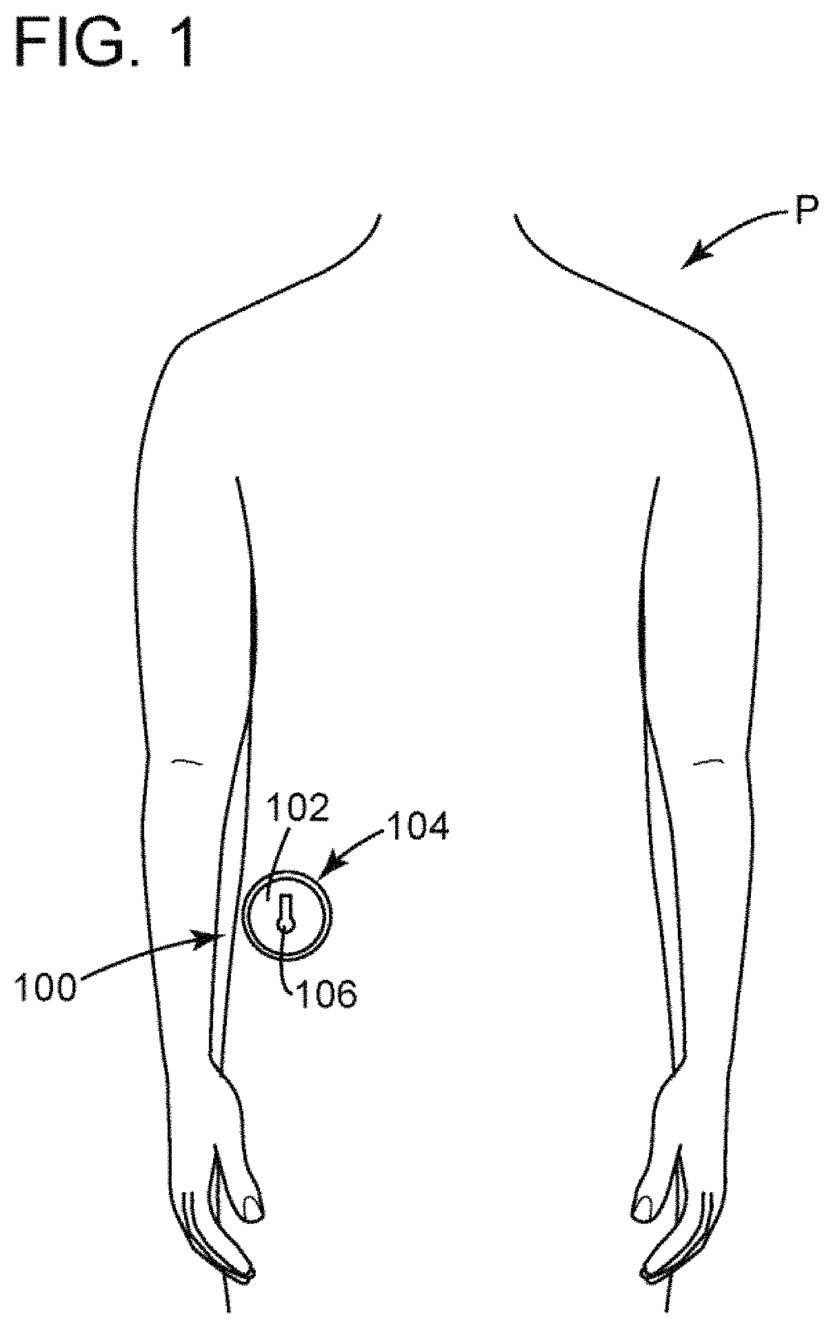 Patent US11771585 — Devices, systems and methods for regulating flow from a stoma on a patient — Figure 1