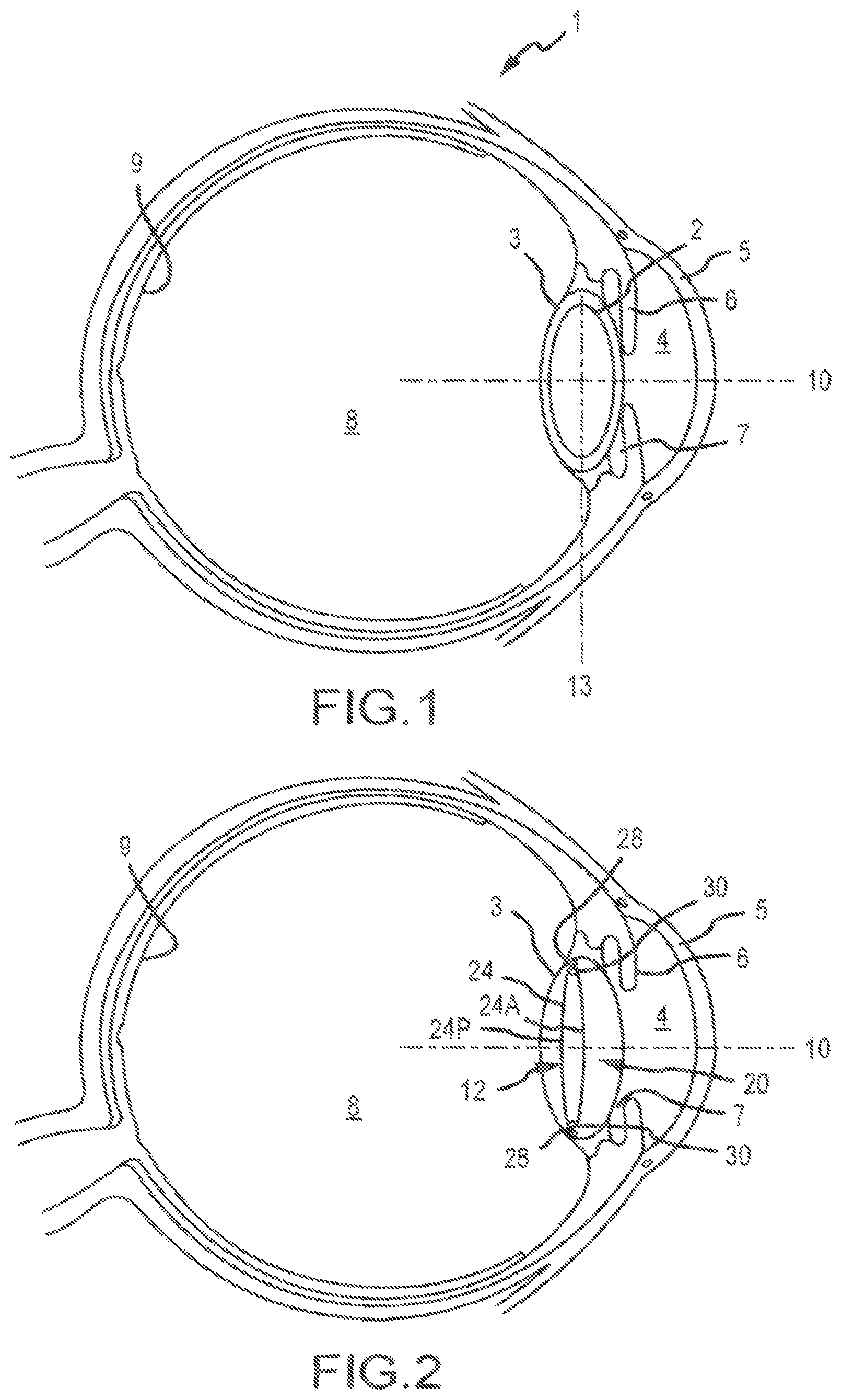 Patent US11771592 — Stabilized intraocular drug delivery systems and methods of use — Figure 1
