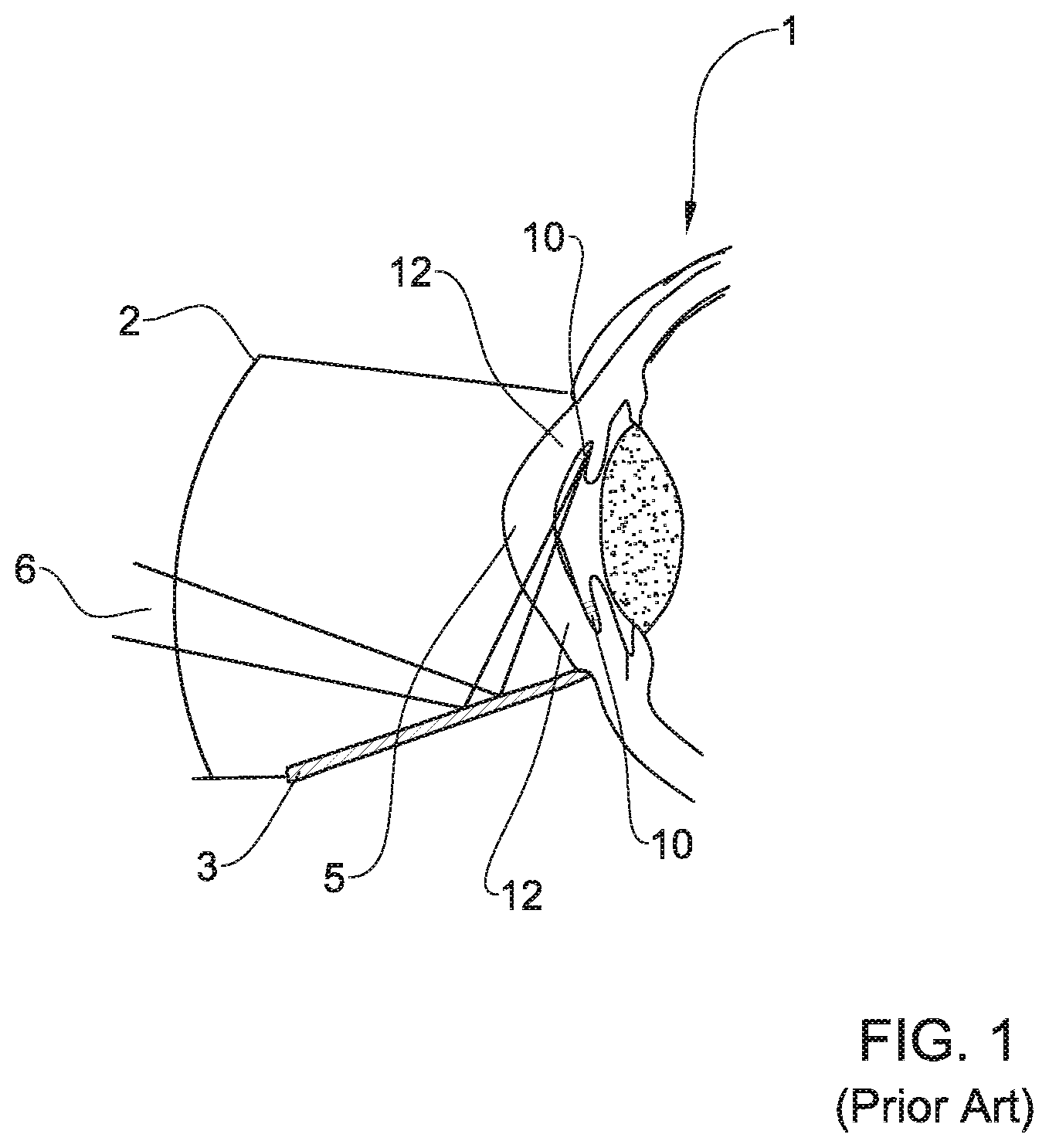 Patent US11771596 — System and method for treating an eye — Figure 1