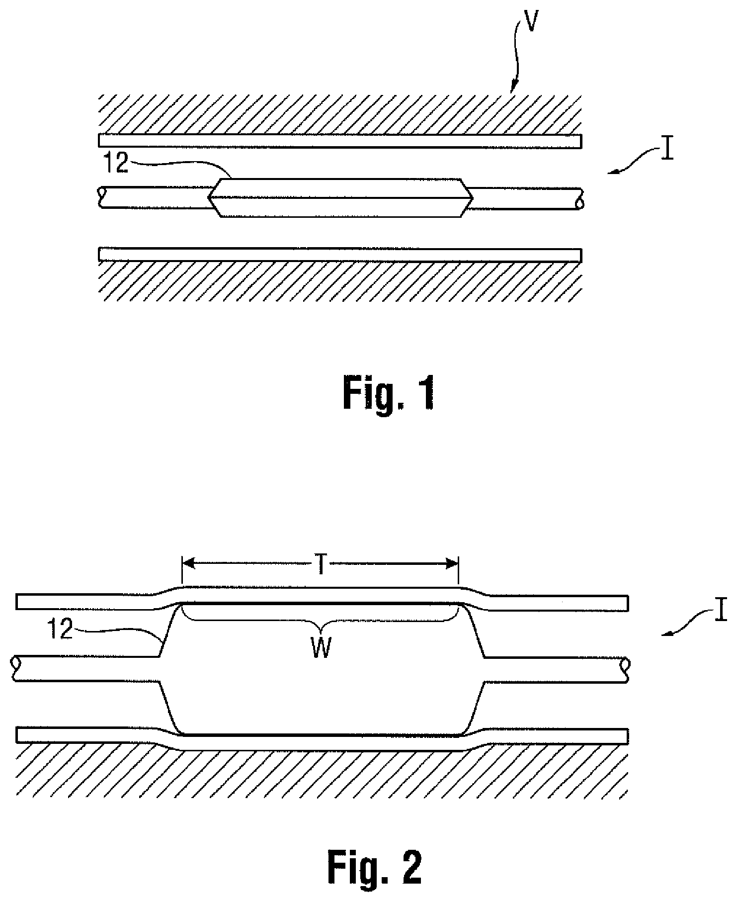 Patent US11771873 — Medical balloon with radiopaque identifier for precisely identifying the working surface — Figure 1