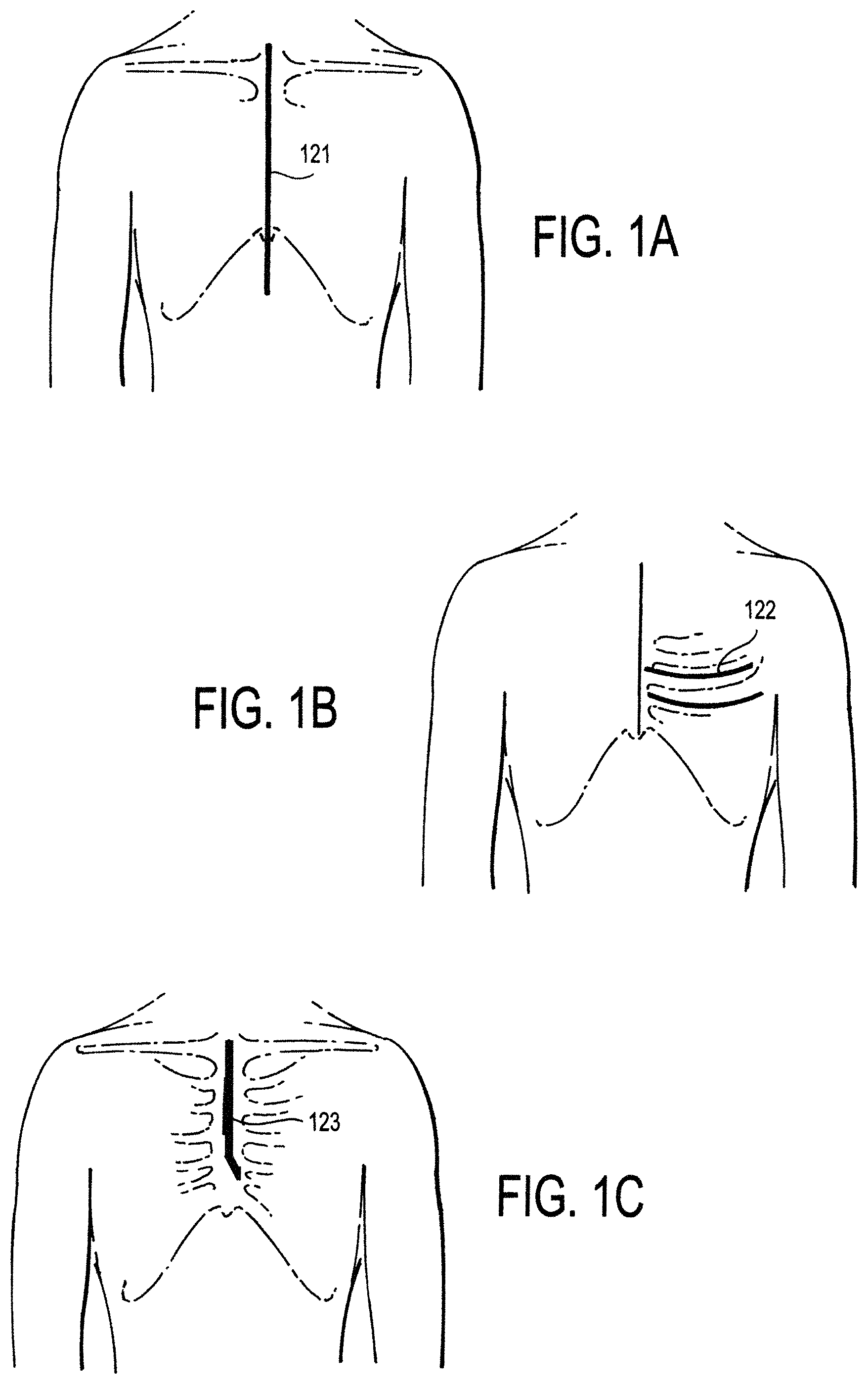 Patent US11771887 — Configurable electrodes and sensors — Figure 1