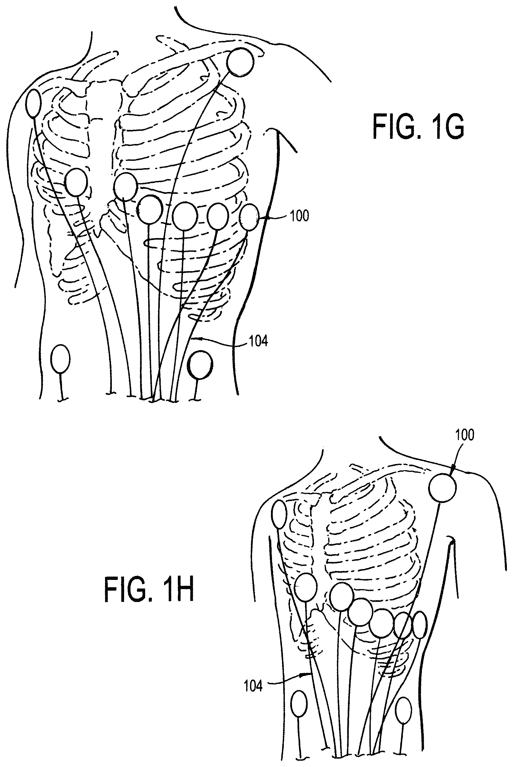 Patent US11771887 Figure 3 – Configurable electrodes and sensors