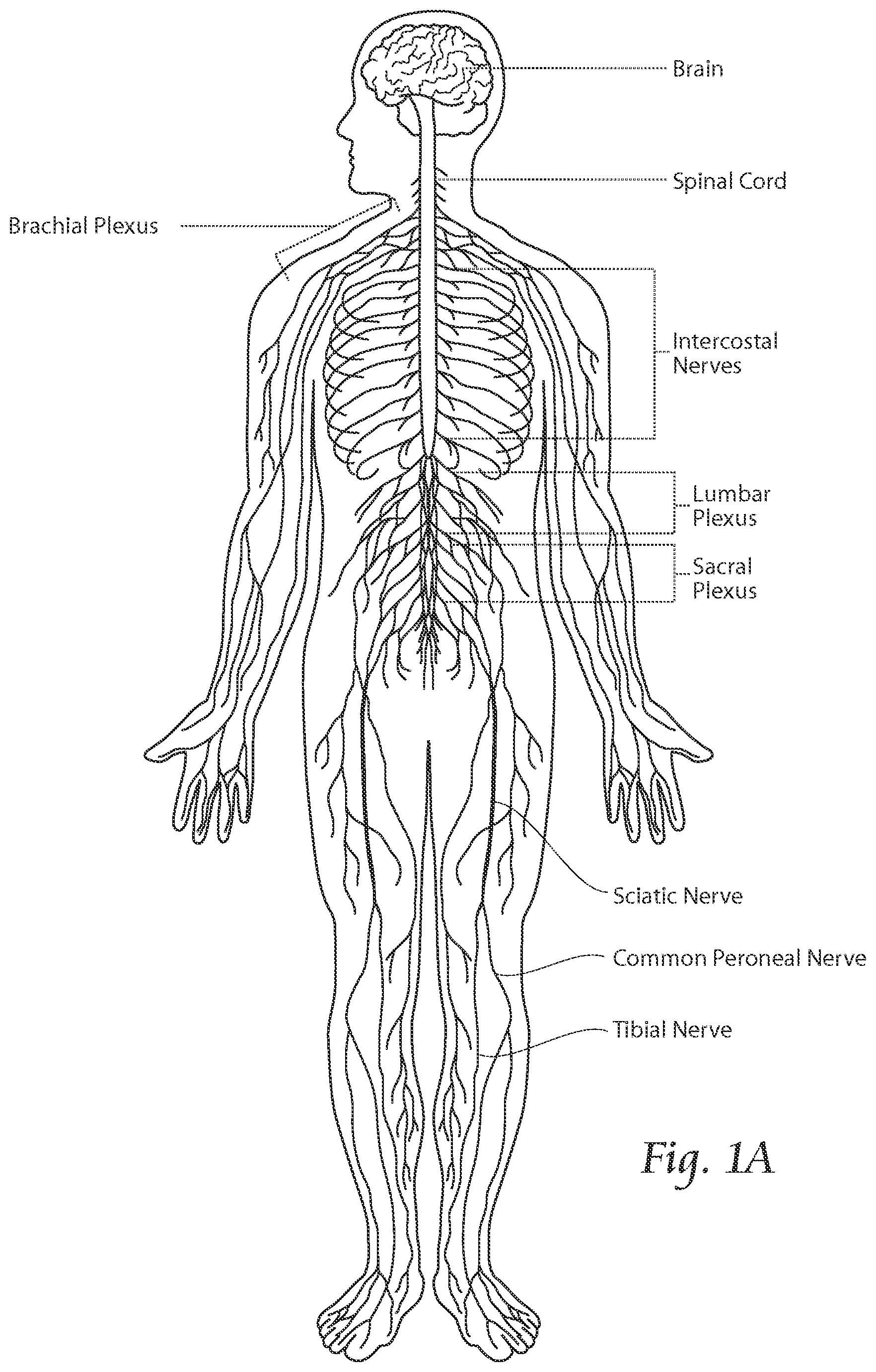Patent US11771891 — Systems and methods to place one or more leads in tissue to electrically stimulate nerves of passage to treat pain — Figure 1