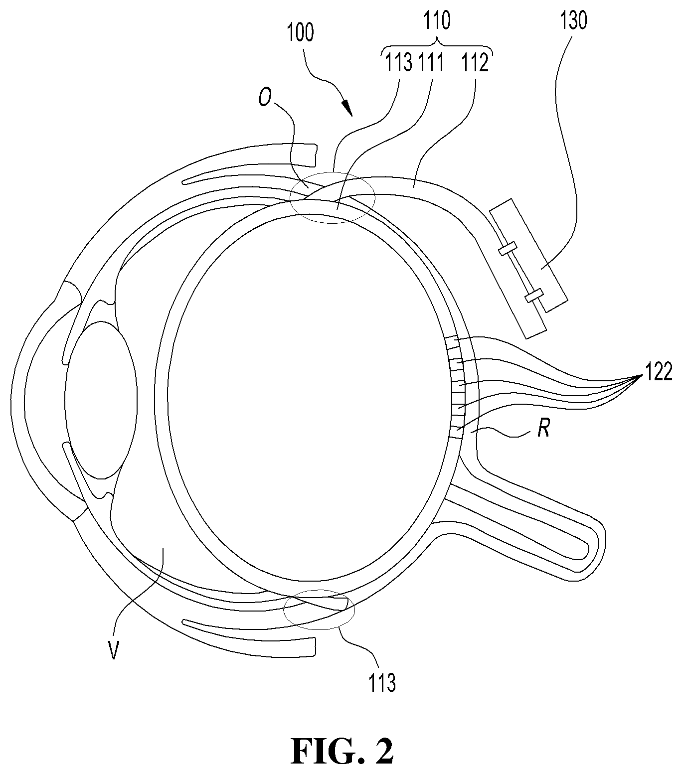 Patent US11771896 Figure 2 – Balloon-type retinal stimulation device and method for manufacturing same