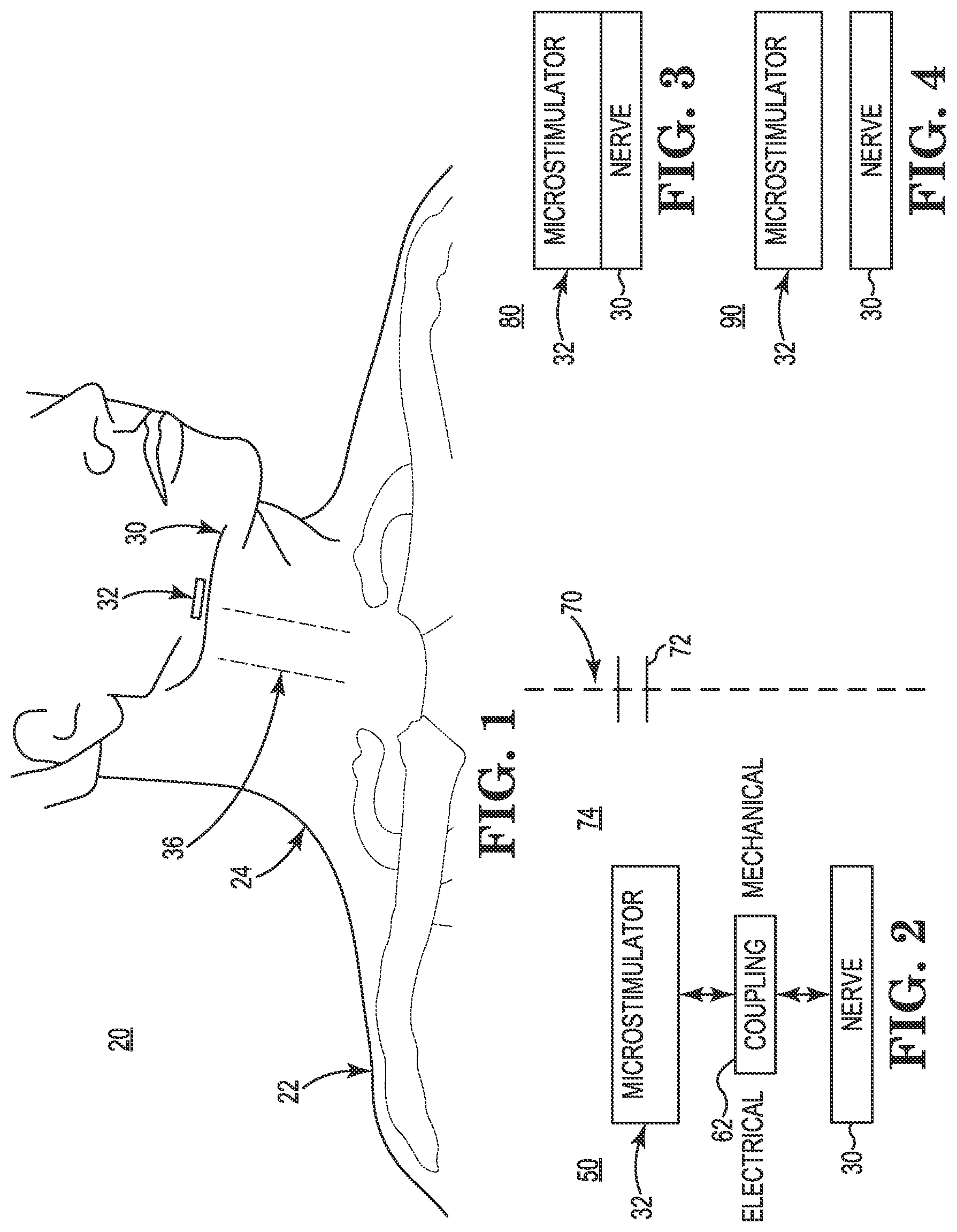 Patent US11771901 — Microstimulation sleep disordered breathing (SDB) therapy device — Figure 1