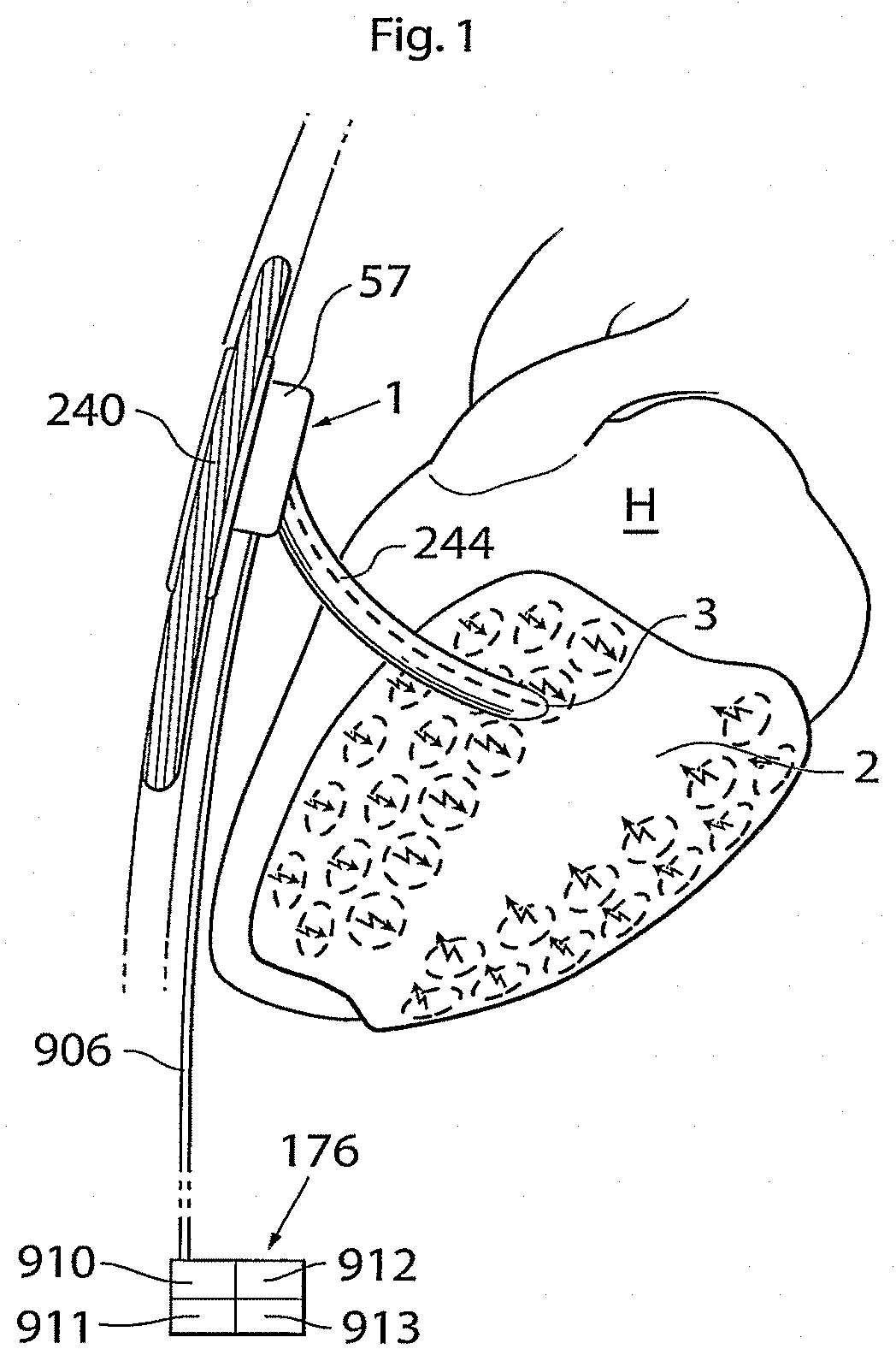 Patent US11771907 Figure 1 – Heart help device, system, and method