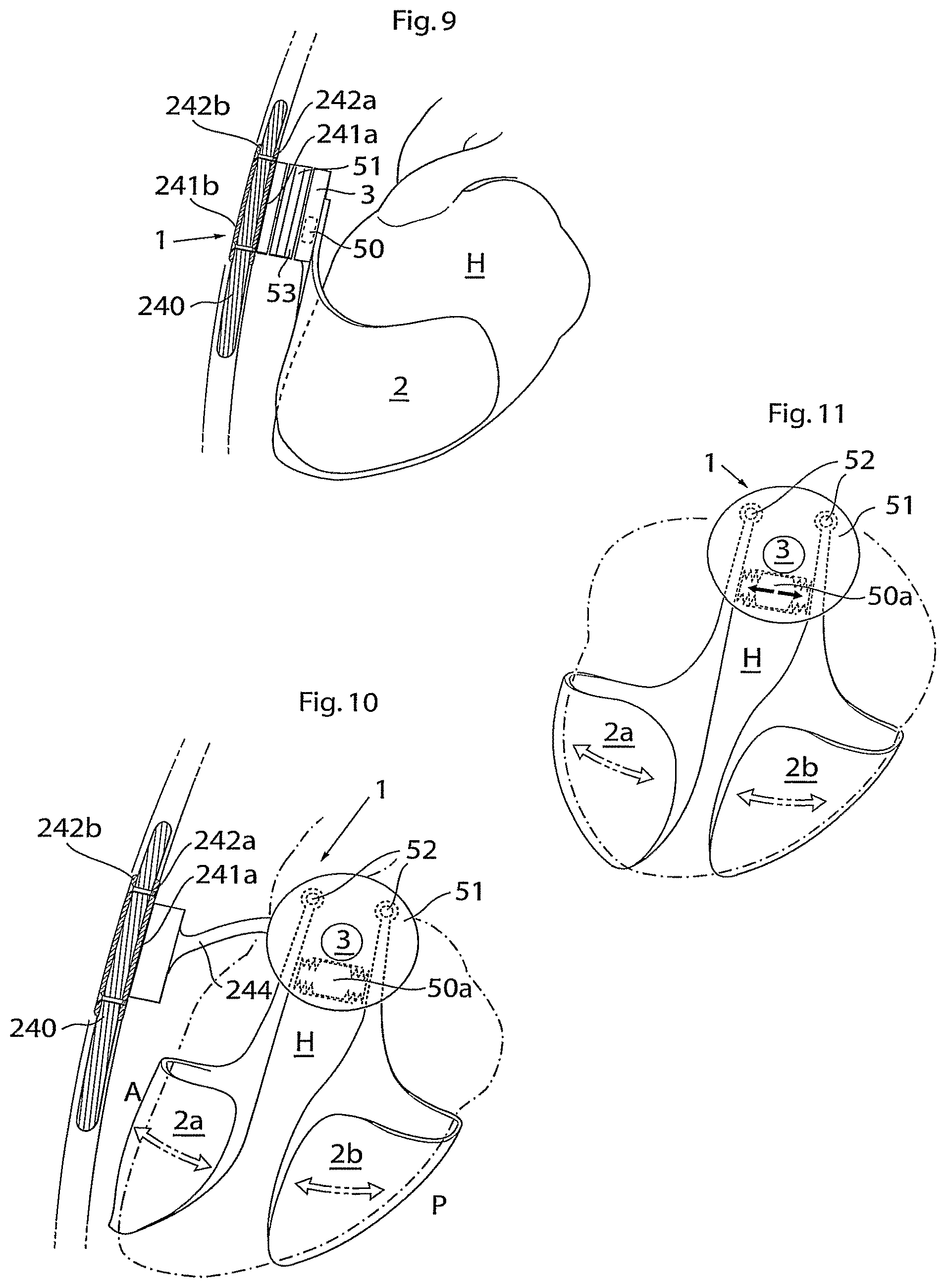 Patent US11771907 Figure 5 – Heart help device, system, and method