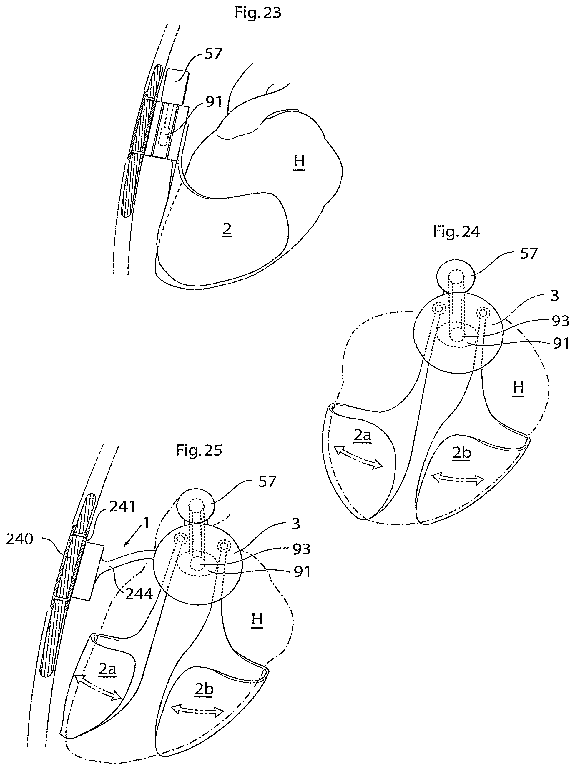 Patent US11771907 Figure 10 – Heart help device, system, and method