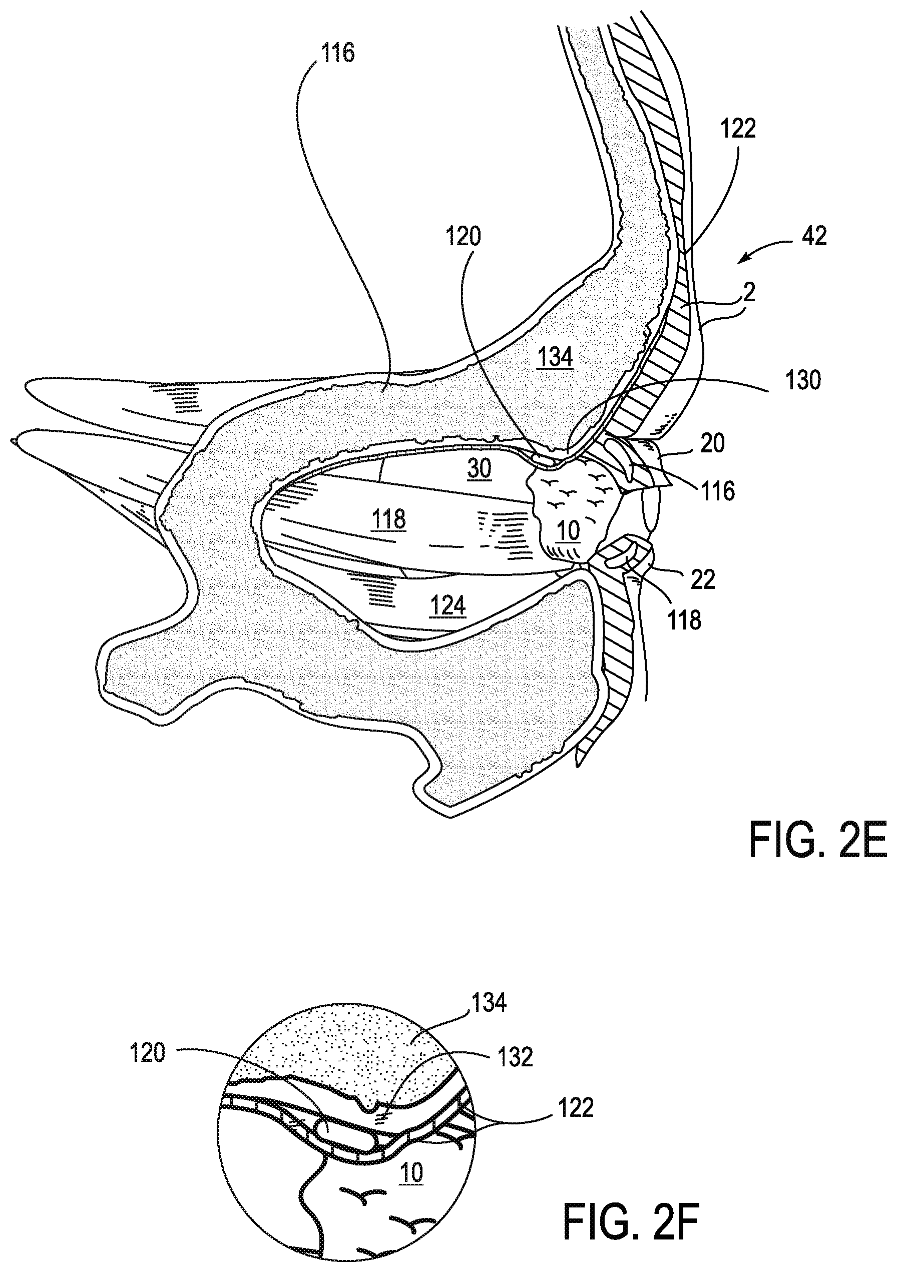 Patent US11771908 Figure 4 – Systems and methods for treatment of dry eye