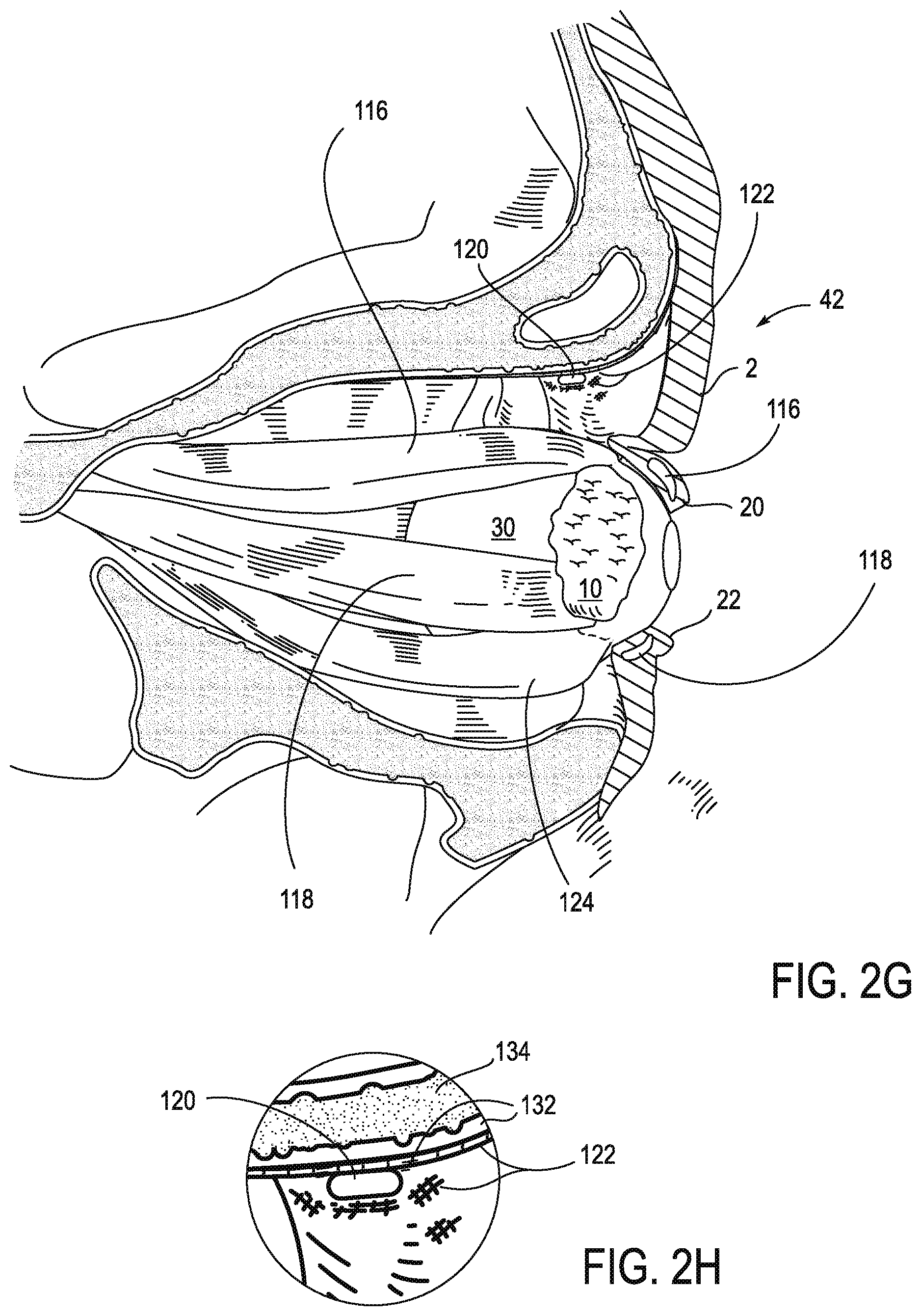 Patent US11771908 Figure 5 – Systems and methods for treatment of dry eye