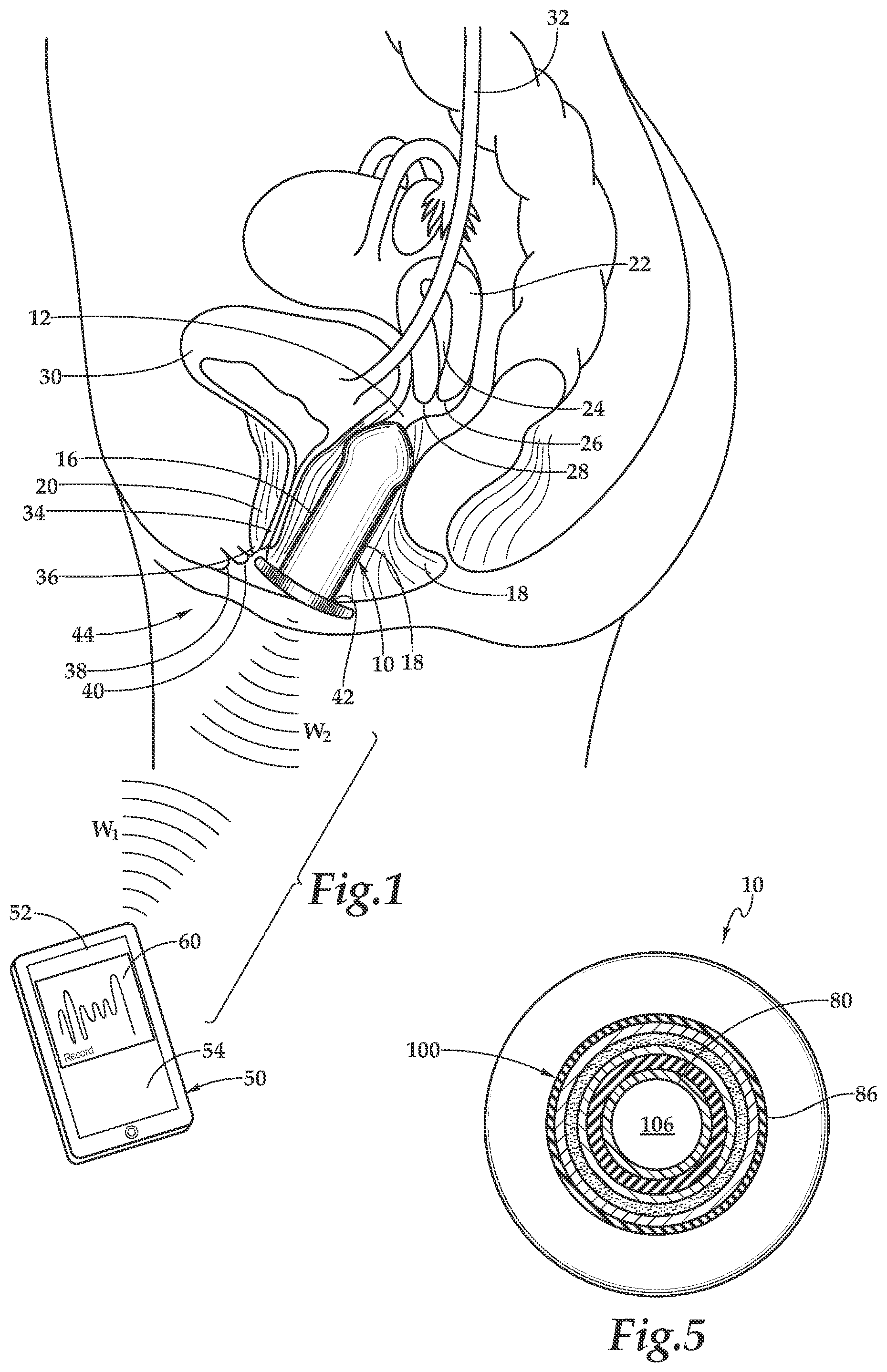Patent US11771953 Figure 1 – Perineometer and method for use of same