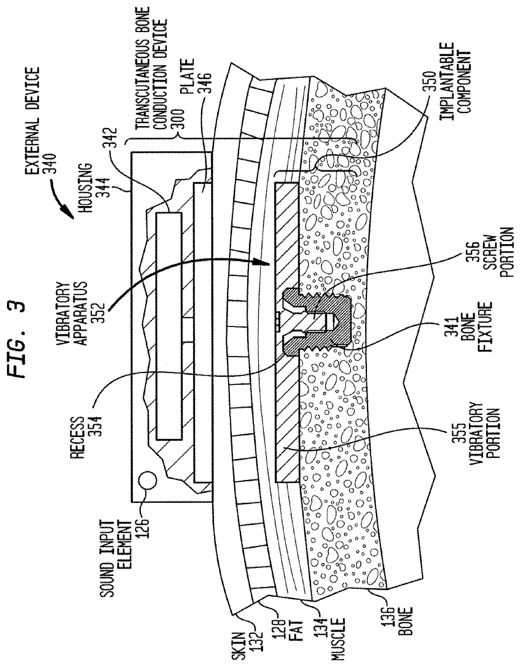 Patent US11778385 Figure 4 – Electromagnetic transducer with non-axial air gap