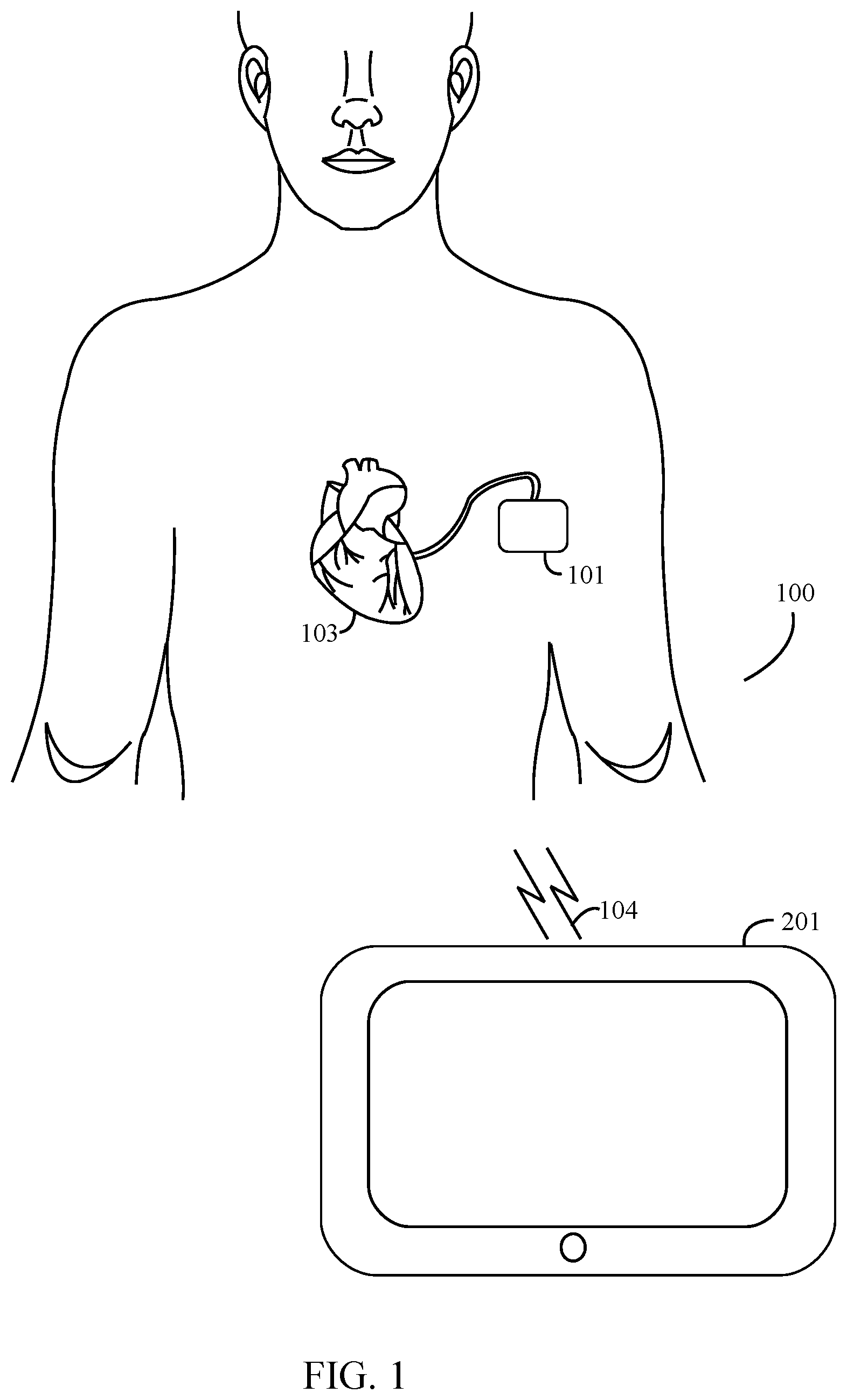 Patent US11778674 — Managing dynamic connection intervals for implantable and external devices — Figure 1